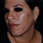 ACNE JUVENIL