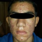 ACNE JUVENIL