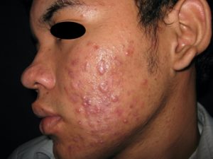 ACNE JUVENIL