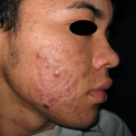 ACNE JUVENIL