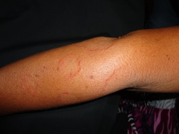 GRANULOMA ANULAR