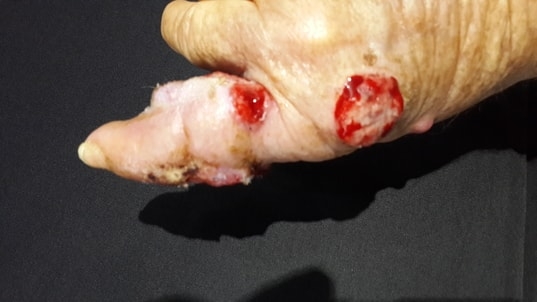 CARCINOMA ESPINOCELULAR