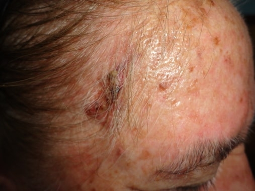 CARCINOMA ESPINOCELULAR