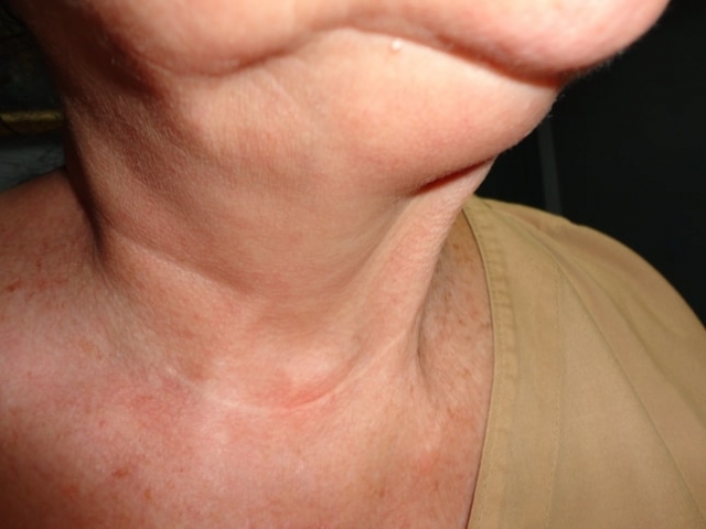 CARCINOMA MUCOCUTÁNEO