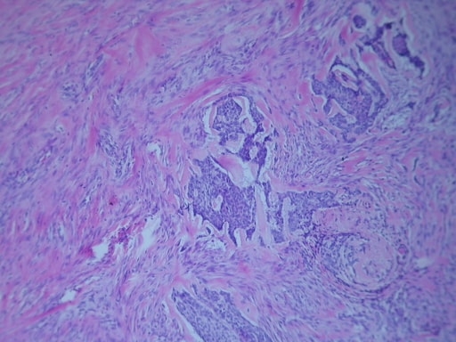 CARCINOMA MUCOCUTÁNEO