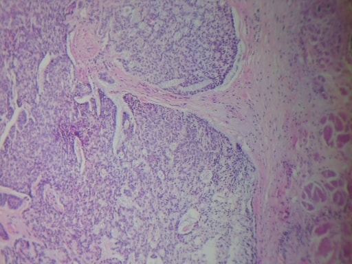 CARCINOMA MUCOCUTÁNEO