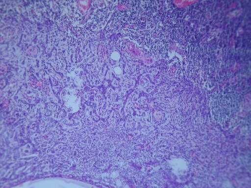 CARCINOMA MUCOCUTÁNEO