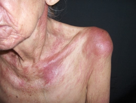 DERMATOMIOSITIS