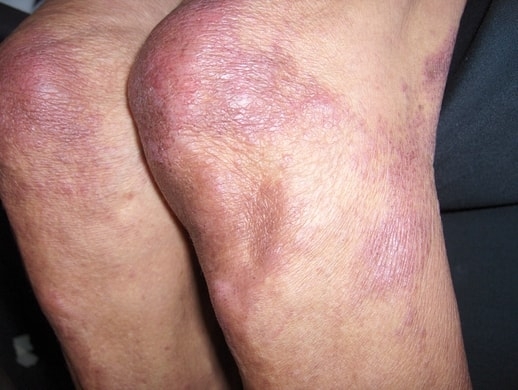 DERMATOMIOSITIS
