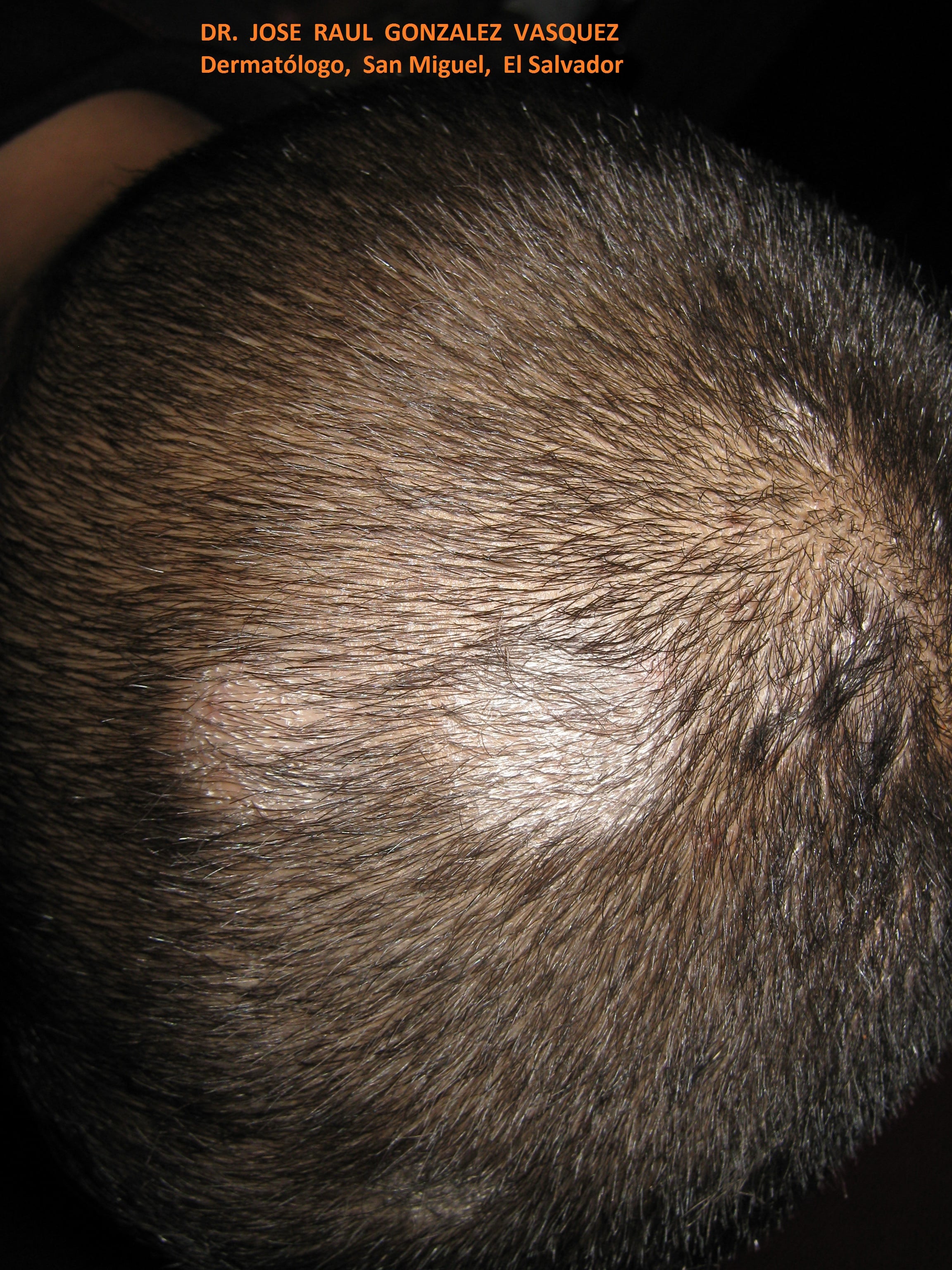 TINEA CABEZA