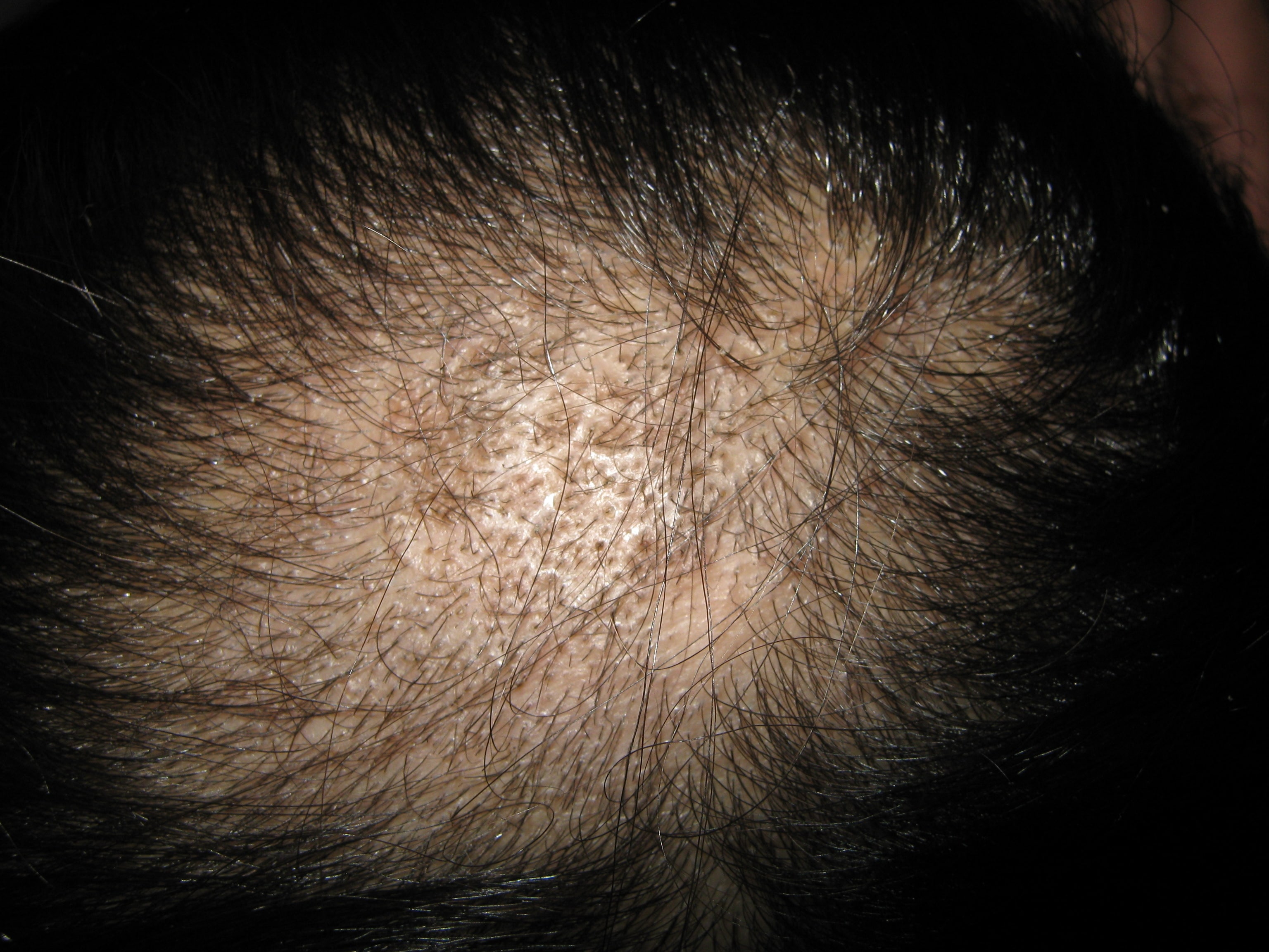 TINEA CABEZA