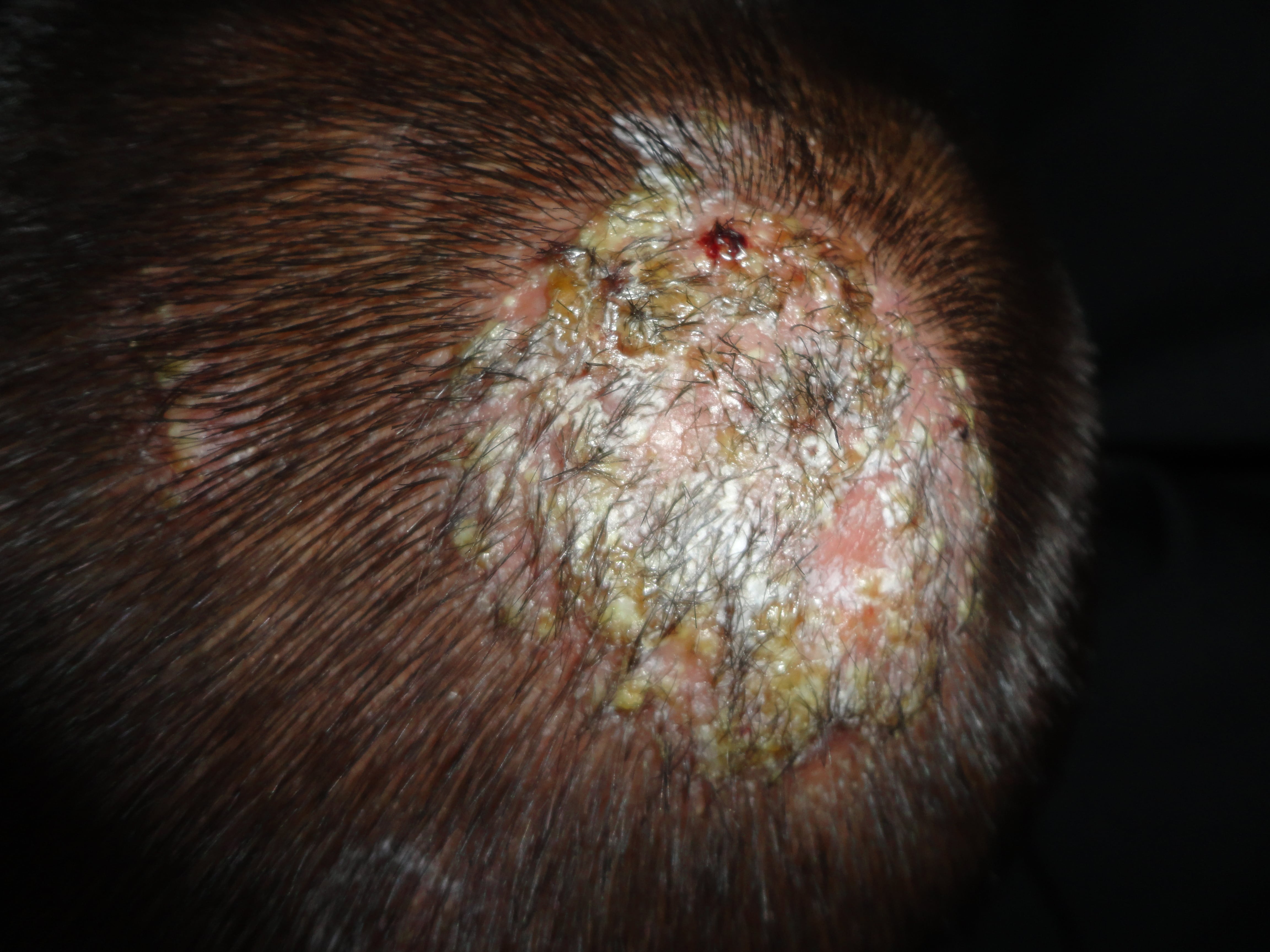 TINEA CABEZA