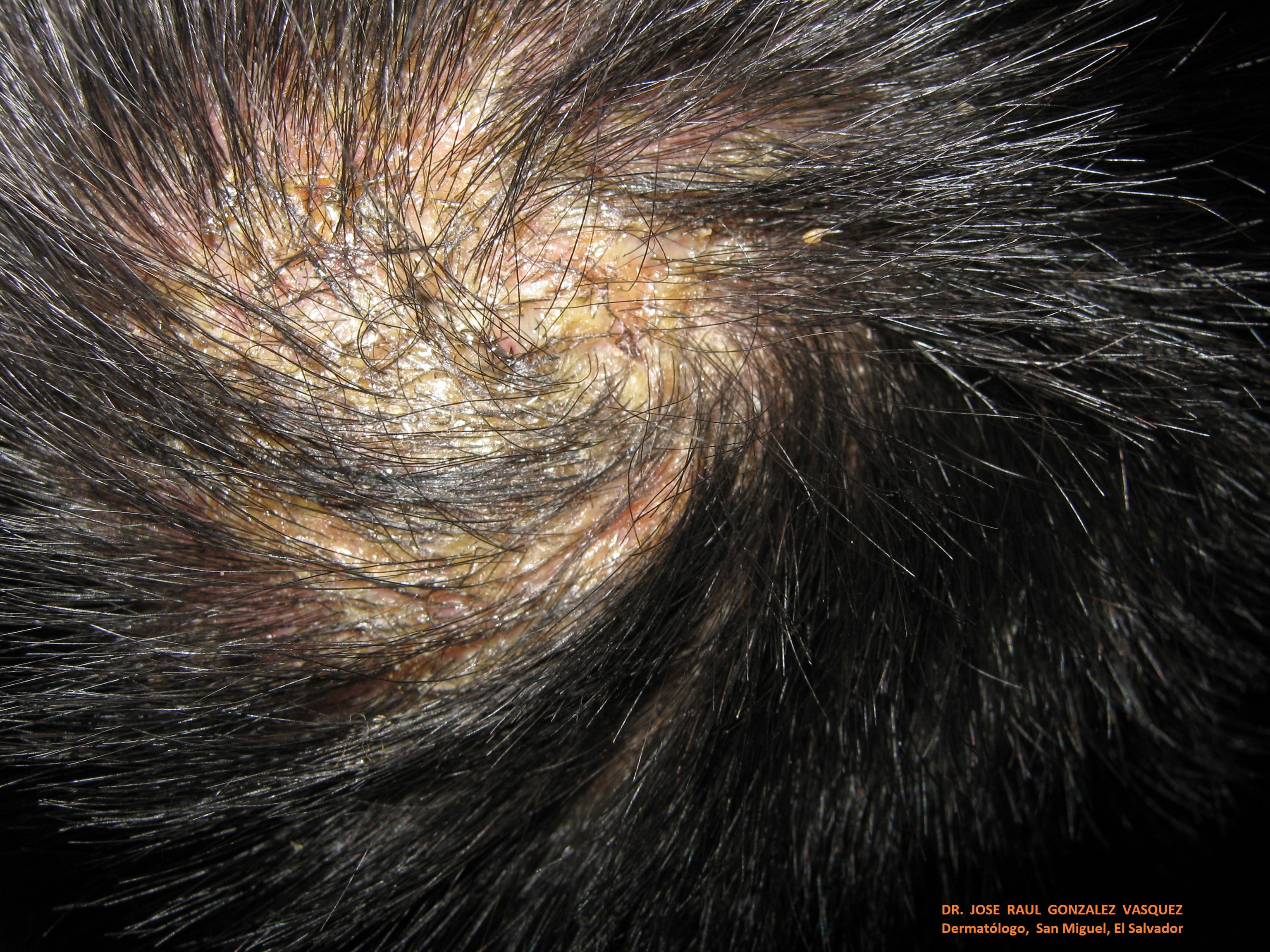 TINEA CABEZA