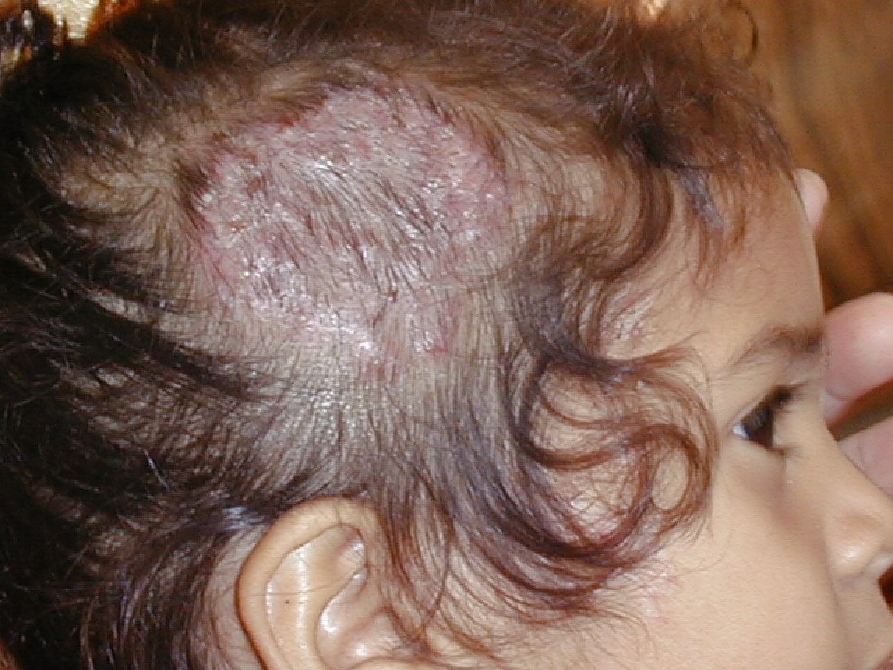 TINEA CABEZA