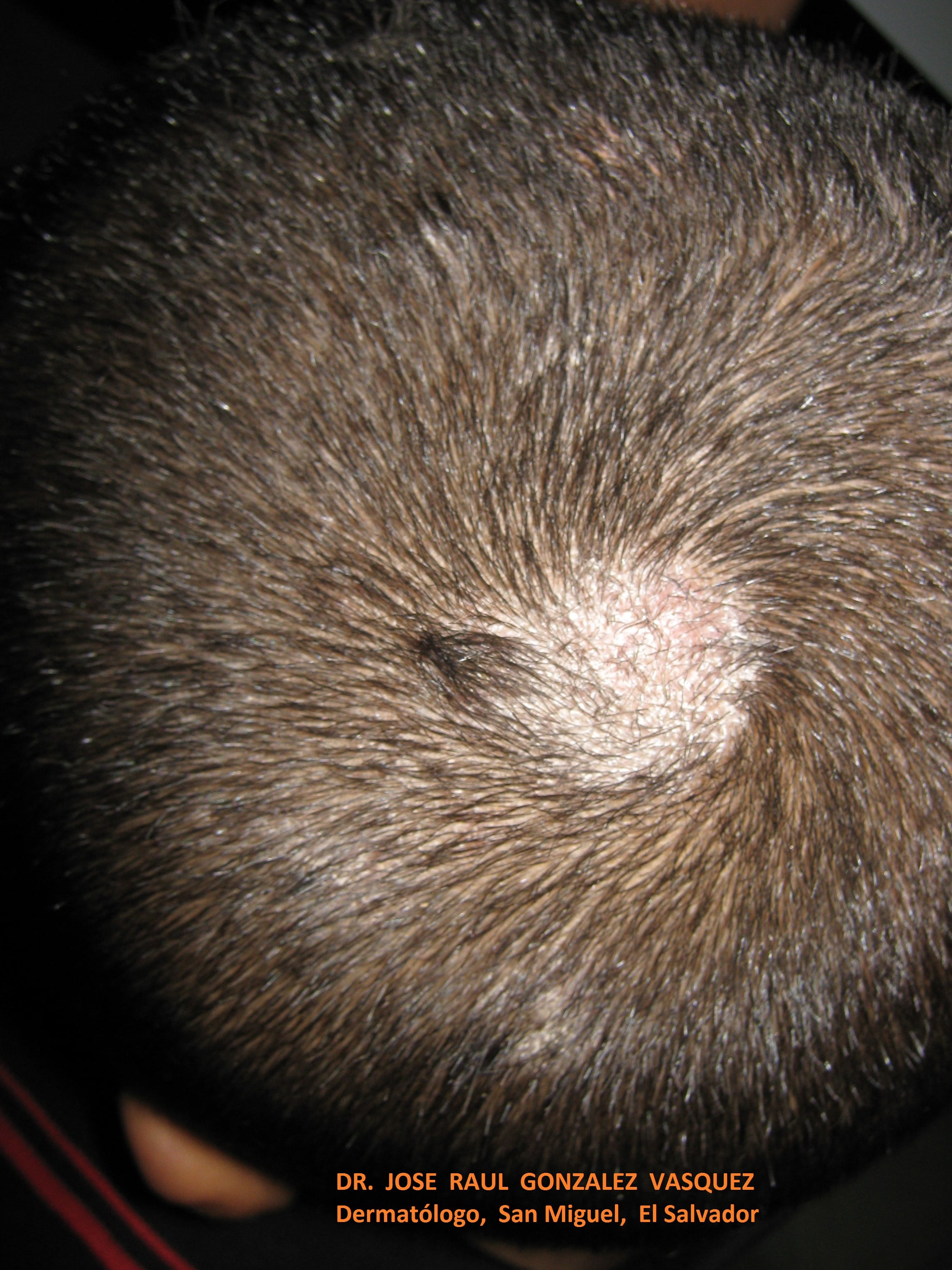 TINEA CABEZA