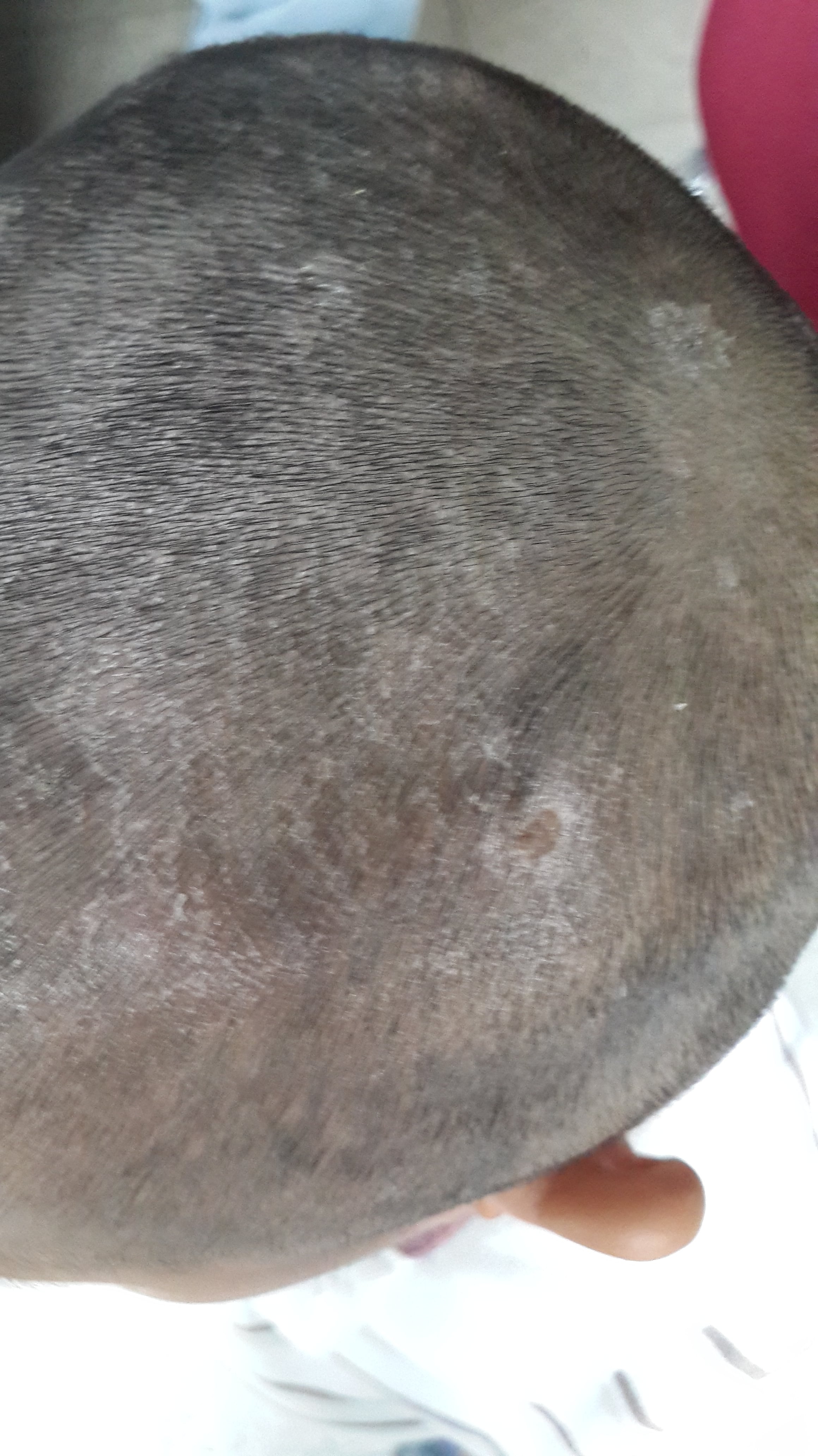 TINEA CABEZA