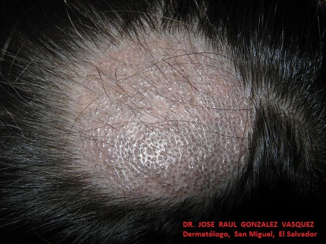TINEA CABEZA