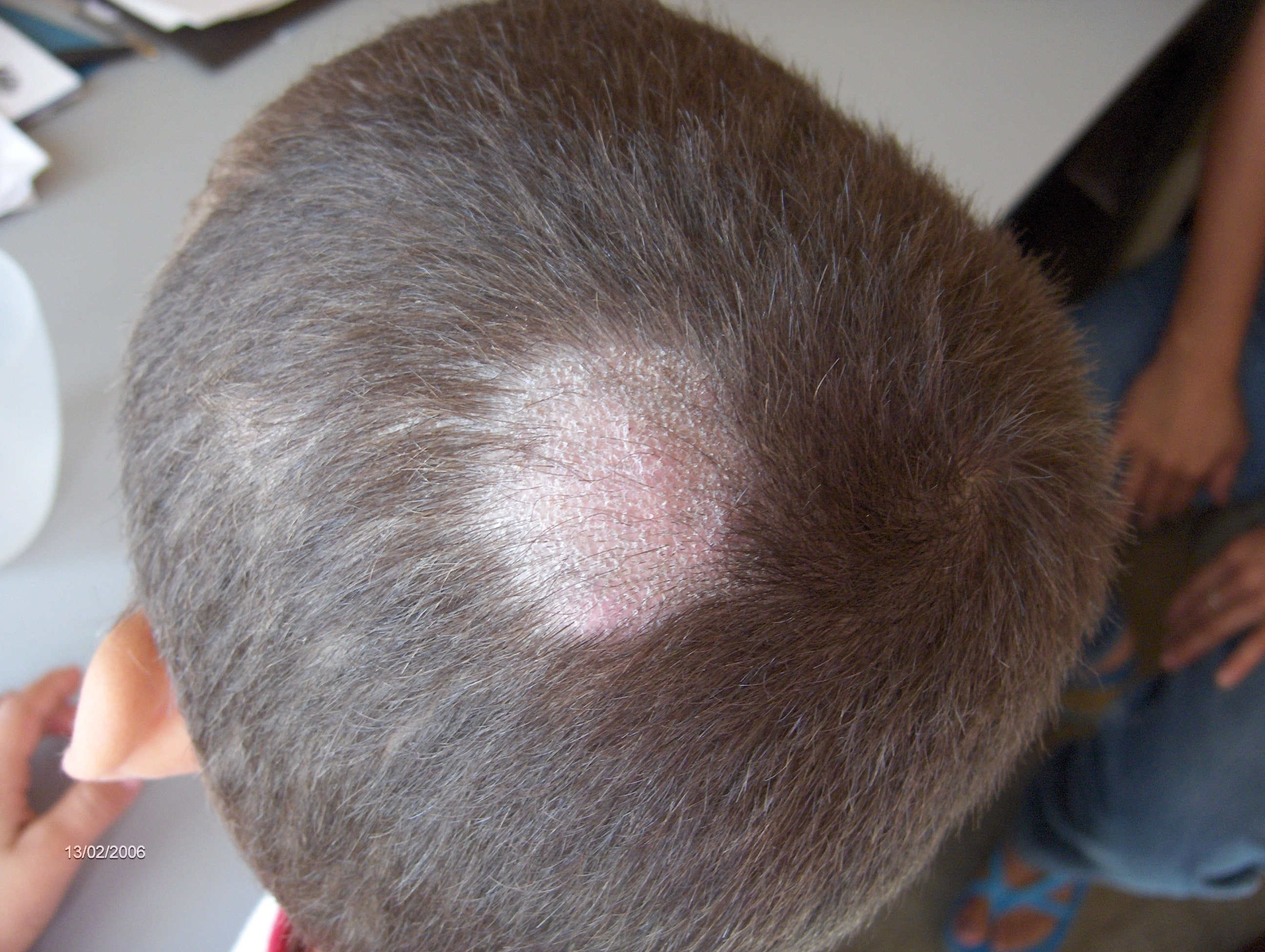 TINEA CABEZA