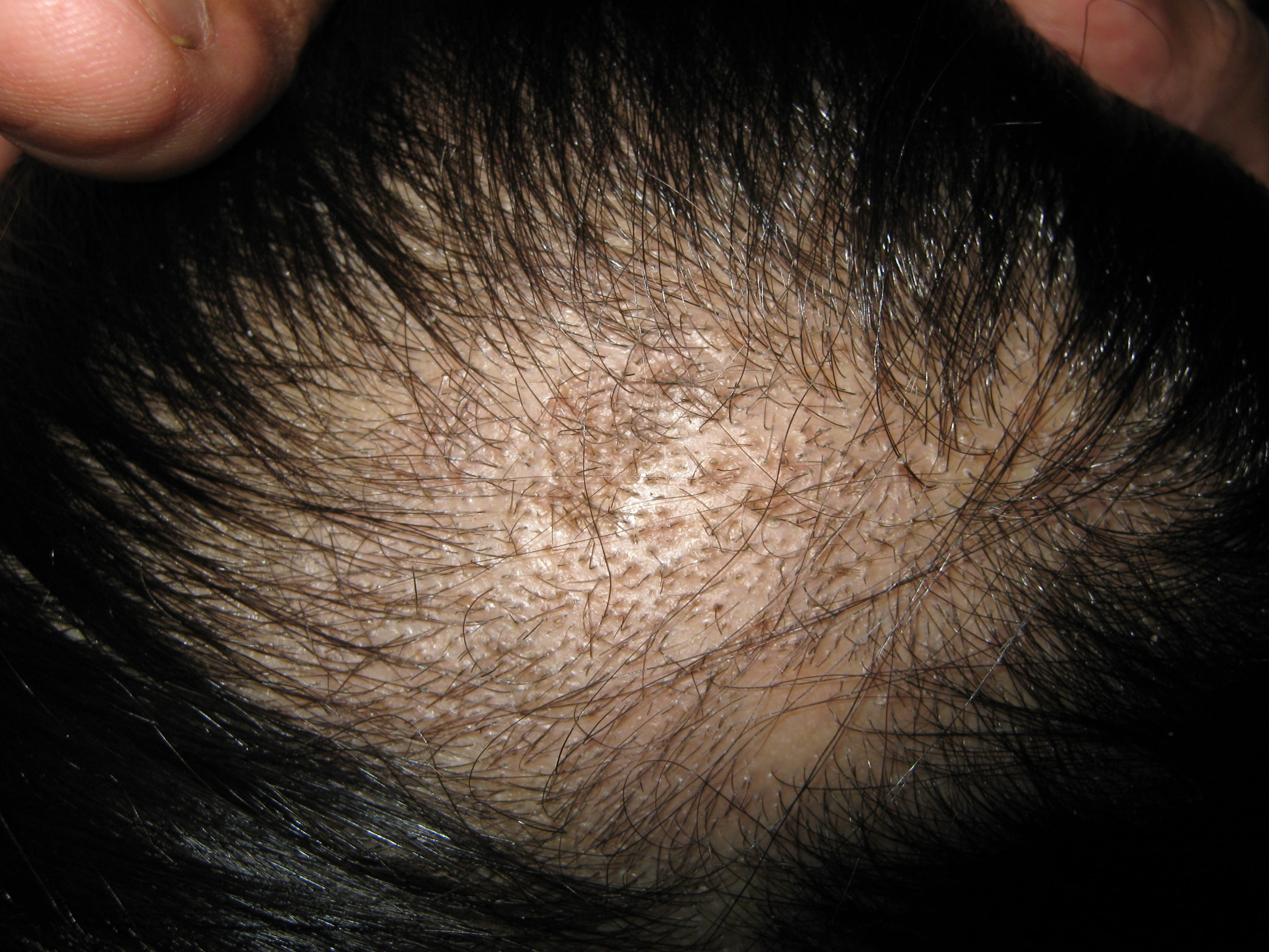 TINEA CABEZA