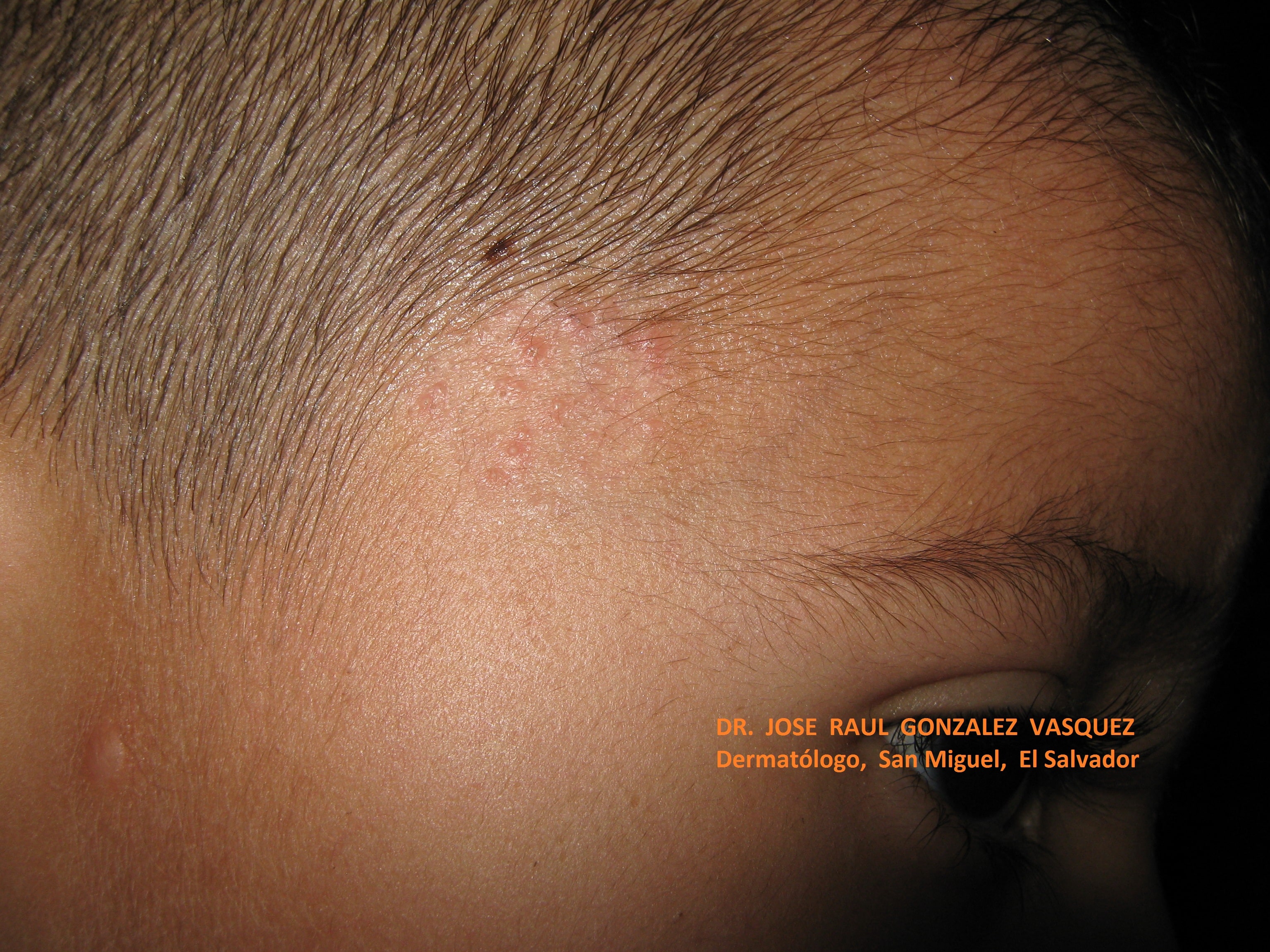 TINEA CABEZA