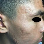 ACNE CONGLOBATA  -  ISOTRETINOINA