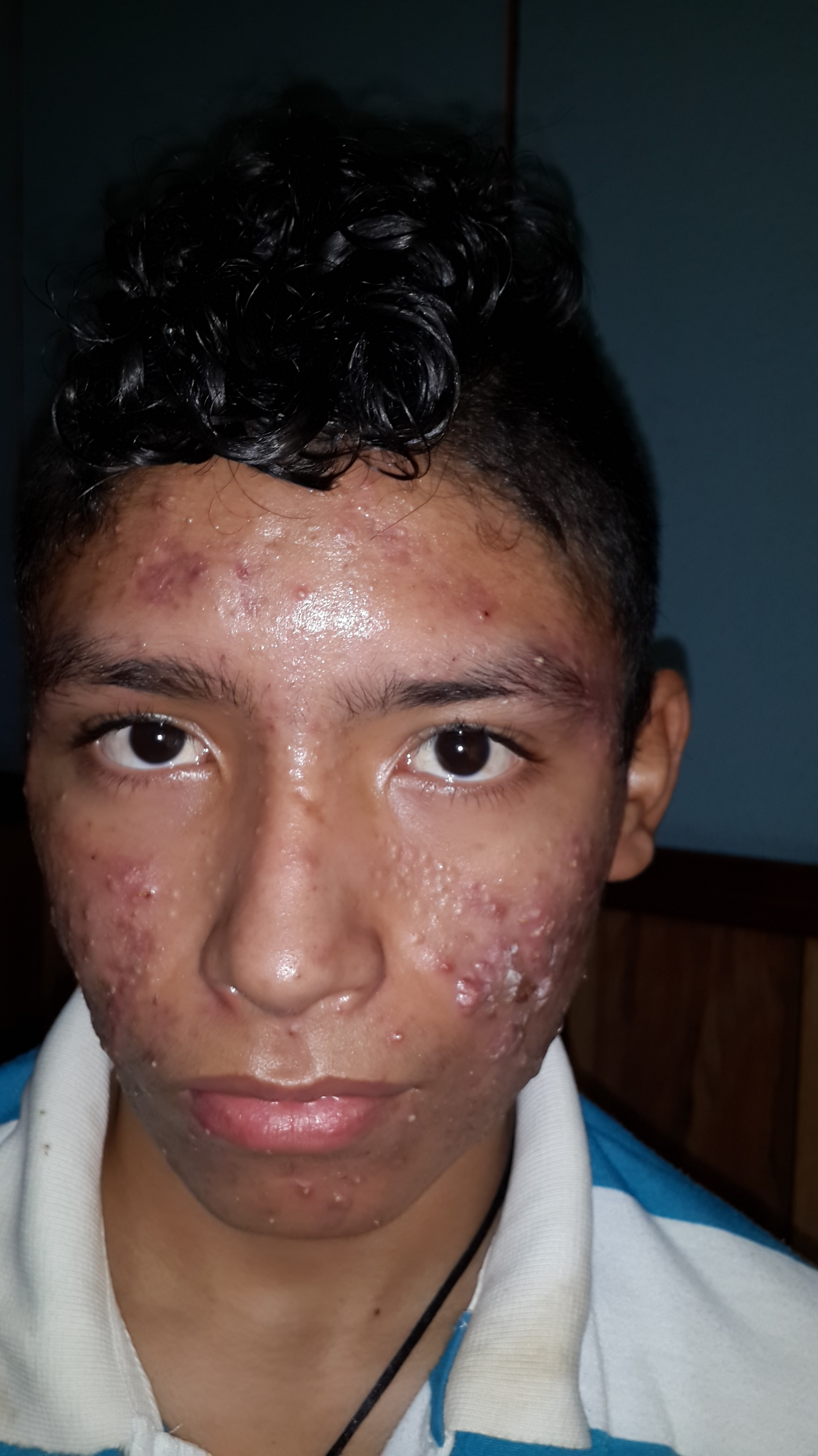 ACNE CONGLOBATA  -  ISOTRETINOINA