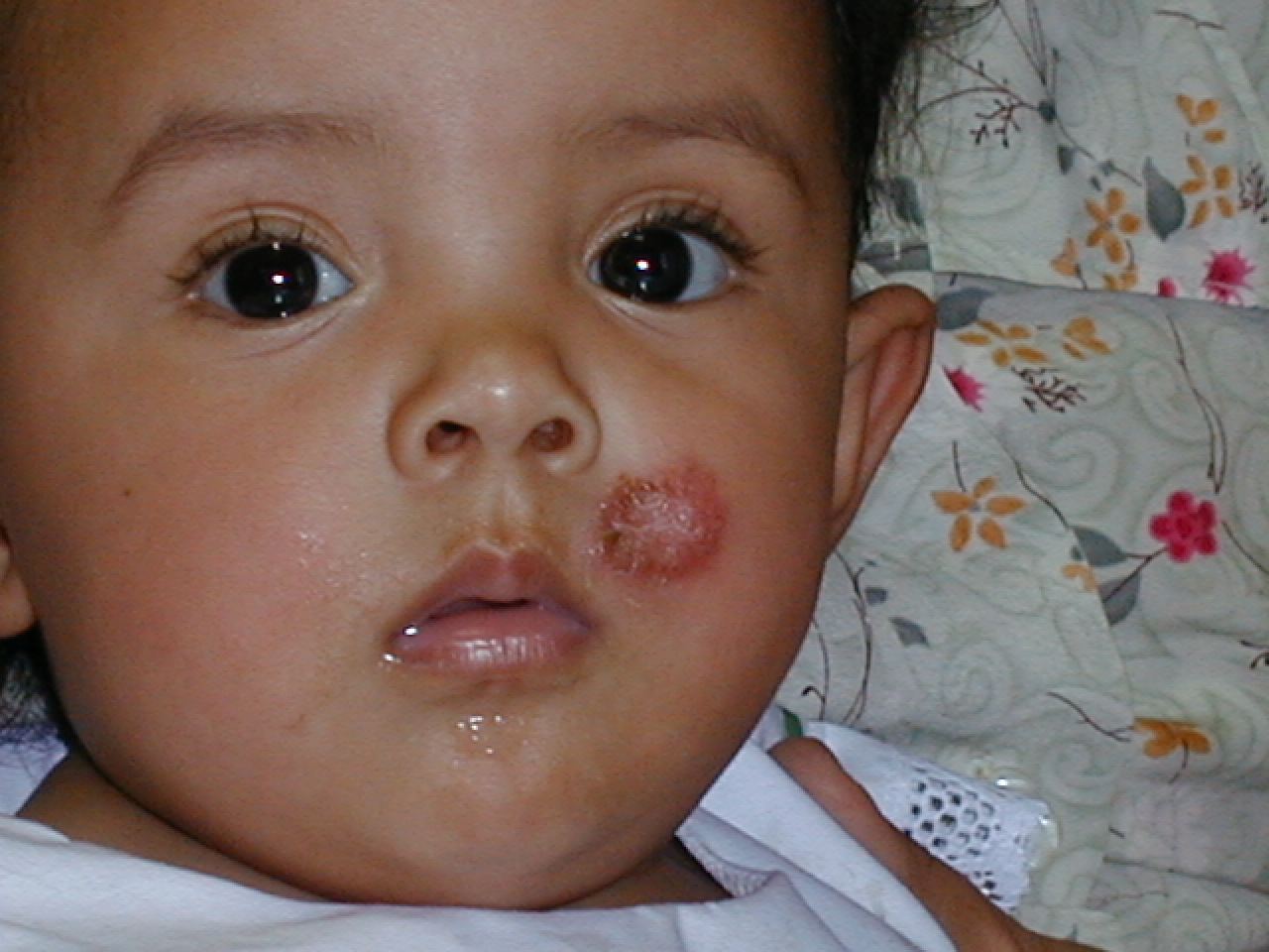 TINEA DE CARA - NIÑOS