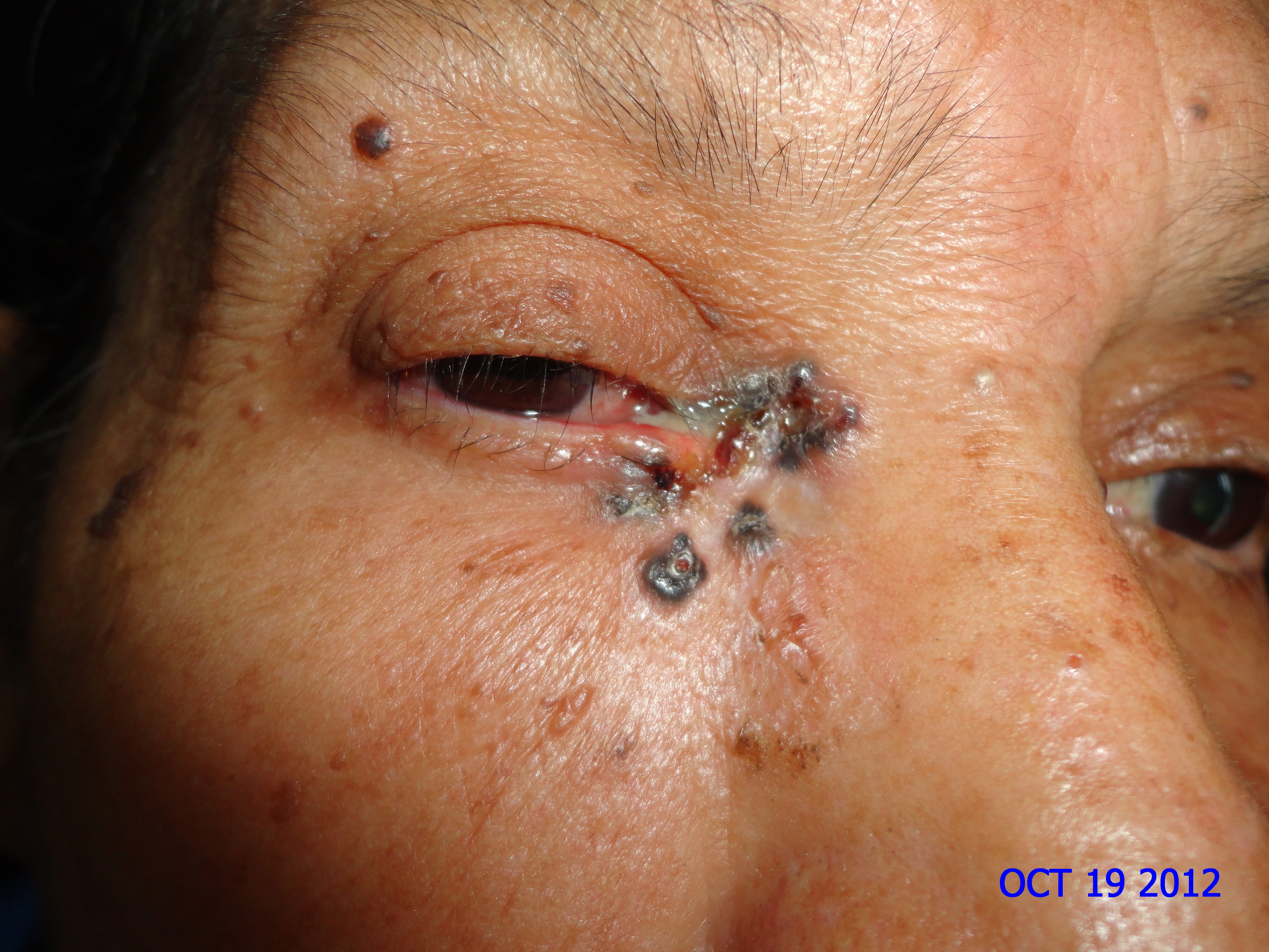 CARCINOMA BASOCELULAR - PARPADO