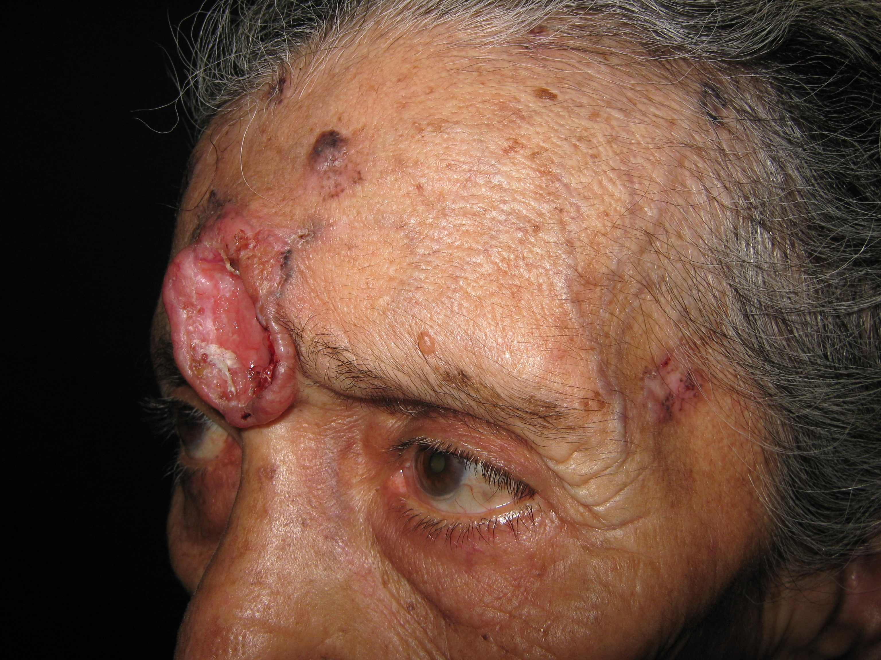 CARCINOMA BASOCELULAR DE LA FRENTE