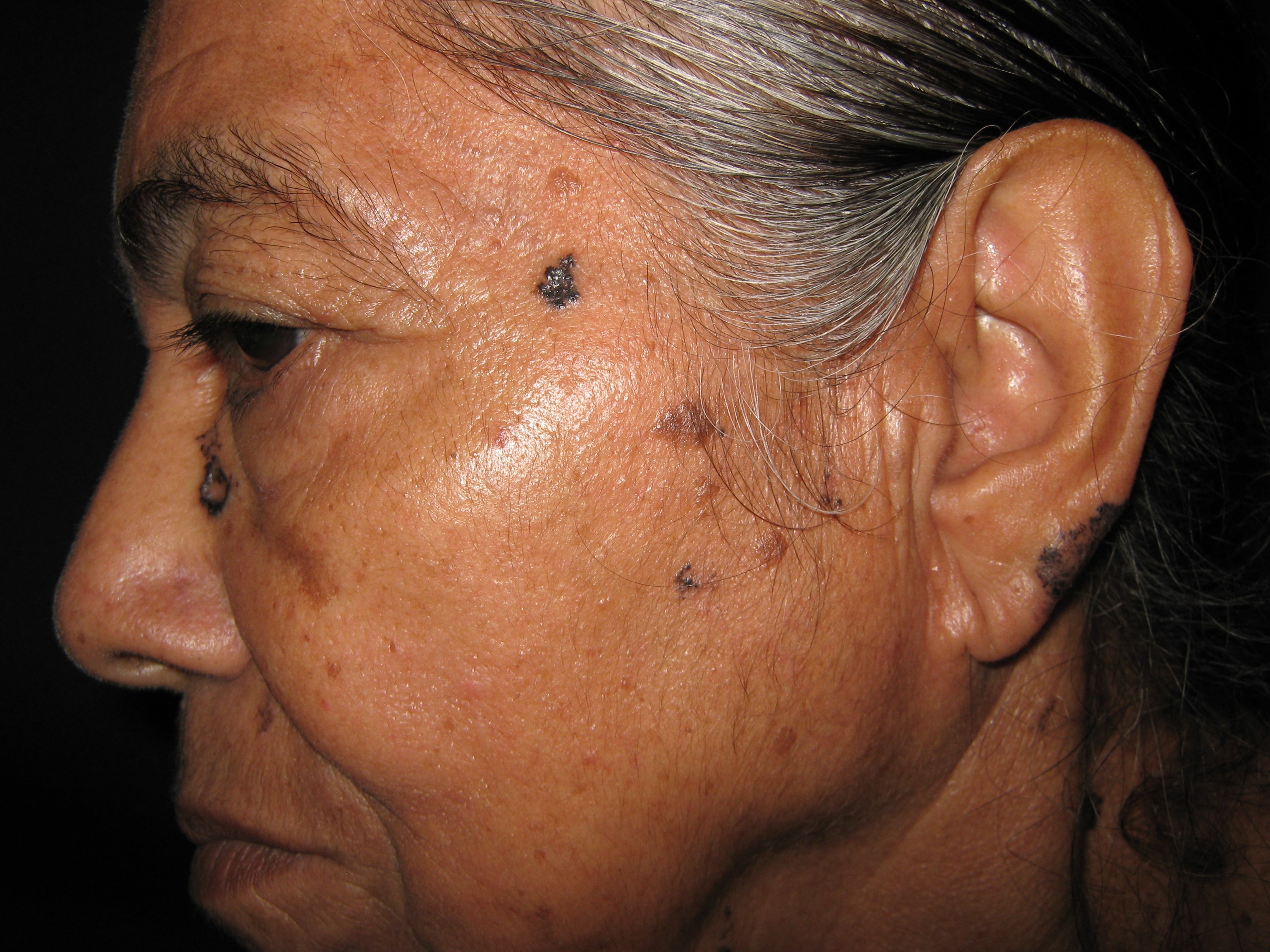 CARCINOMA BASOCELULAR MULTIPLES