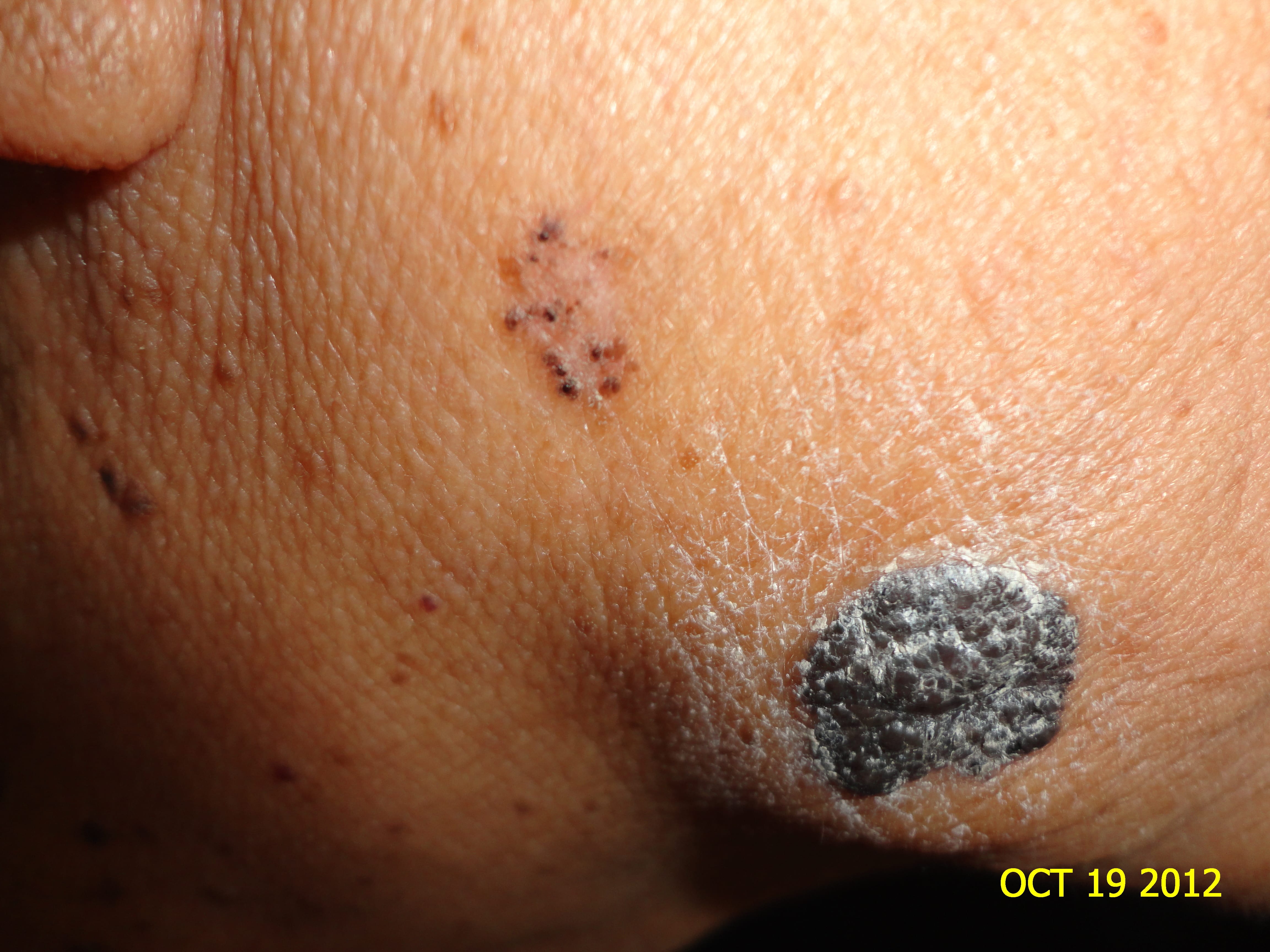 CARCINOMA BASOCELULAR MULTIPLES