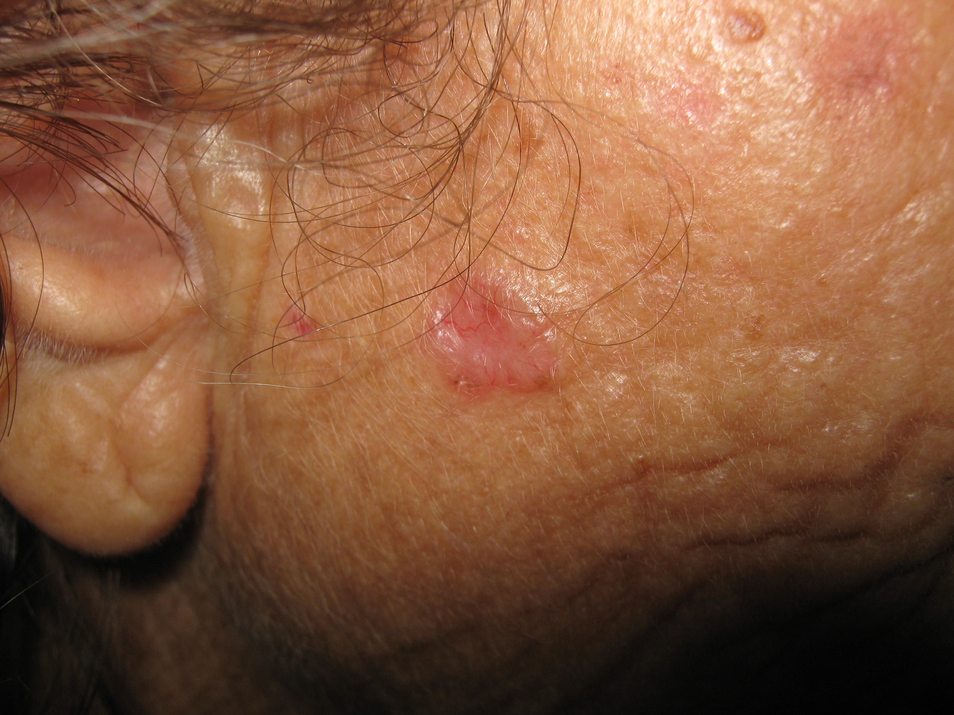 CARCINOMA BASOCELULA DE LA CARA