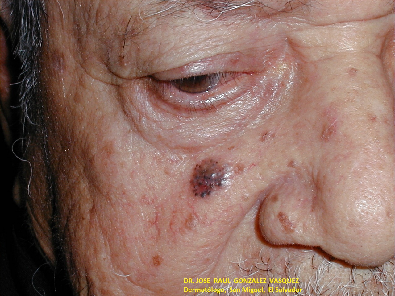 CARCINOMA BASOCELULA DE LA CARA