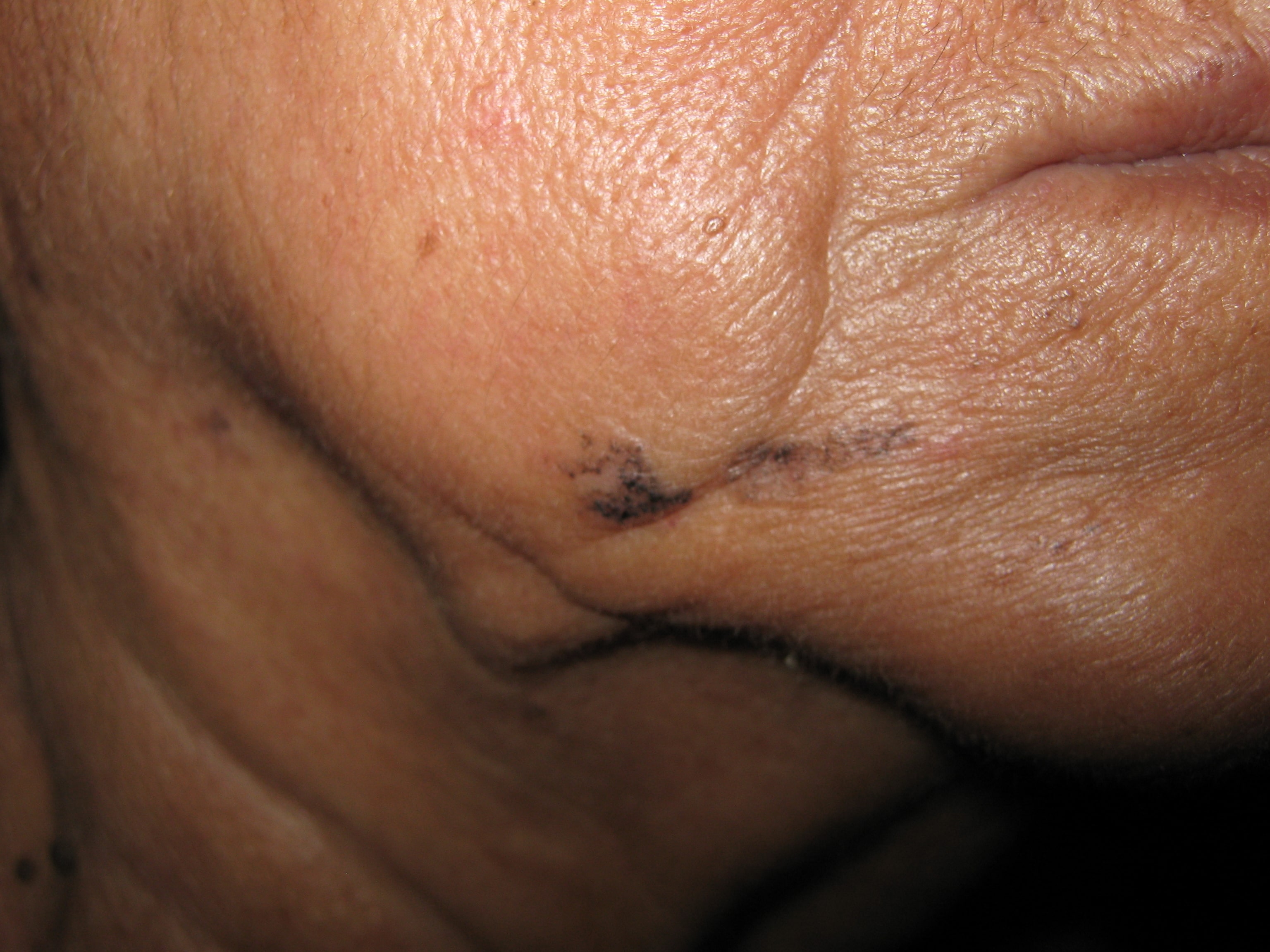 CARCINOMA BASOCELULA DE LA CARA