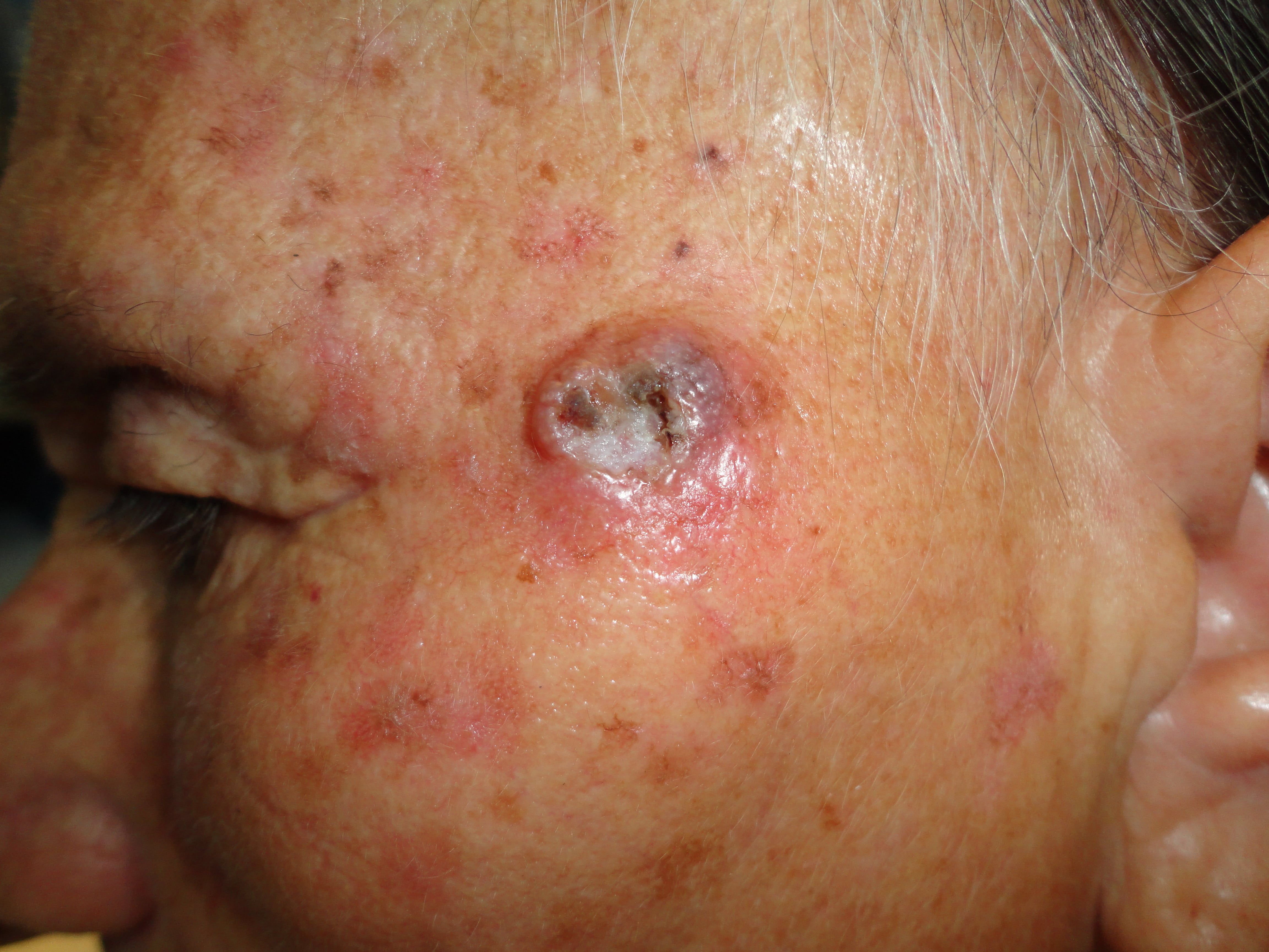 CARCINOMA BASOCELULA DE LA CARA