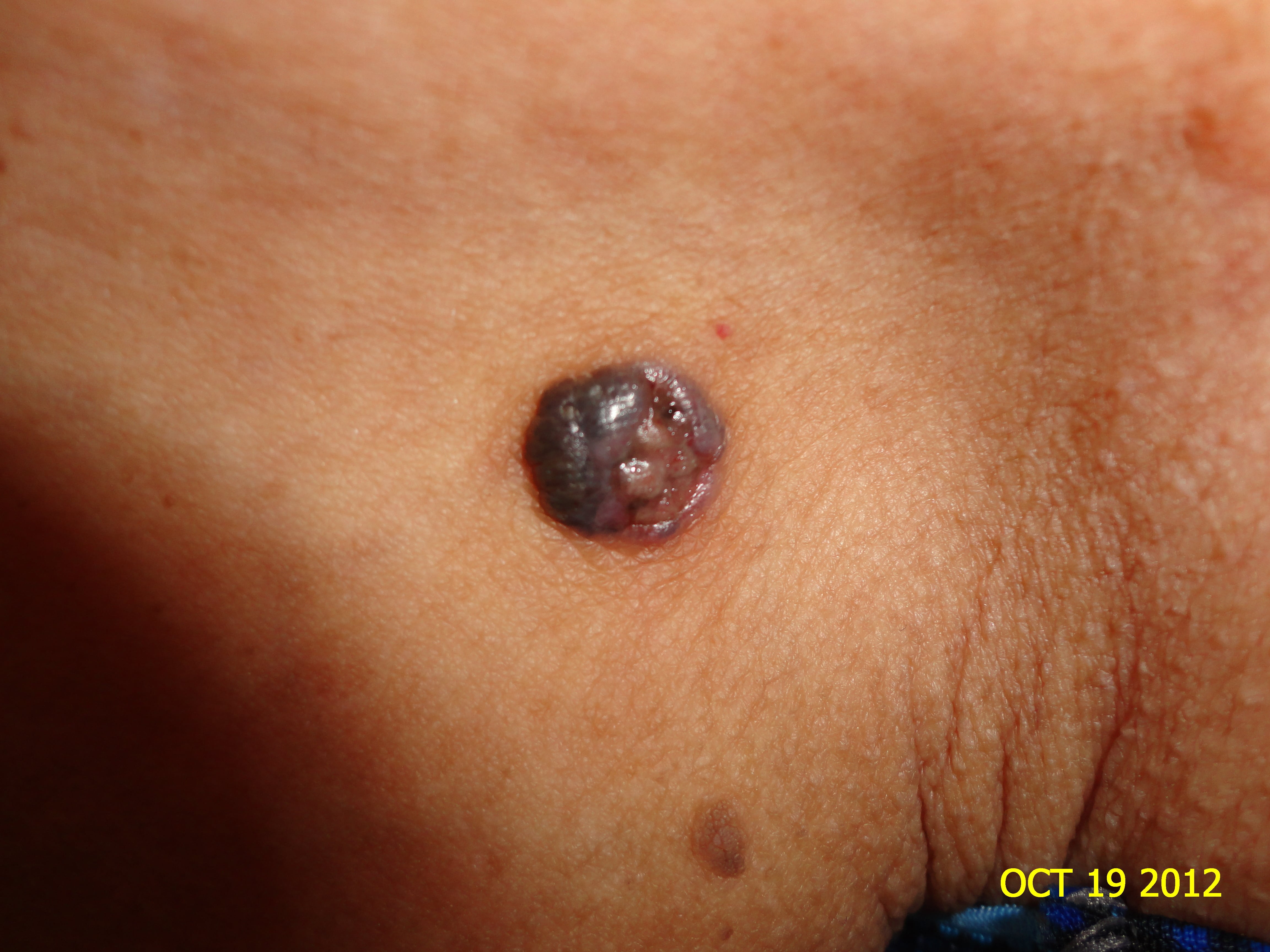 CARCINOMA BASOCELULAR DE LA CARA