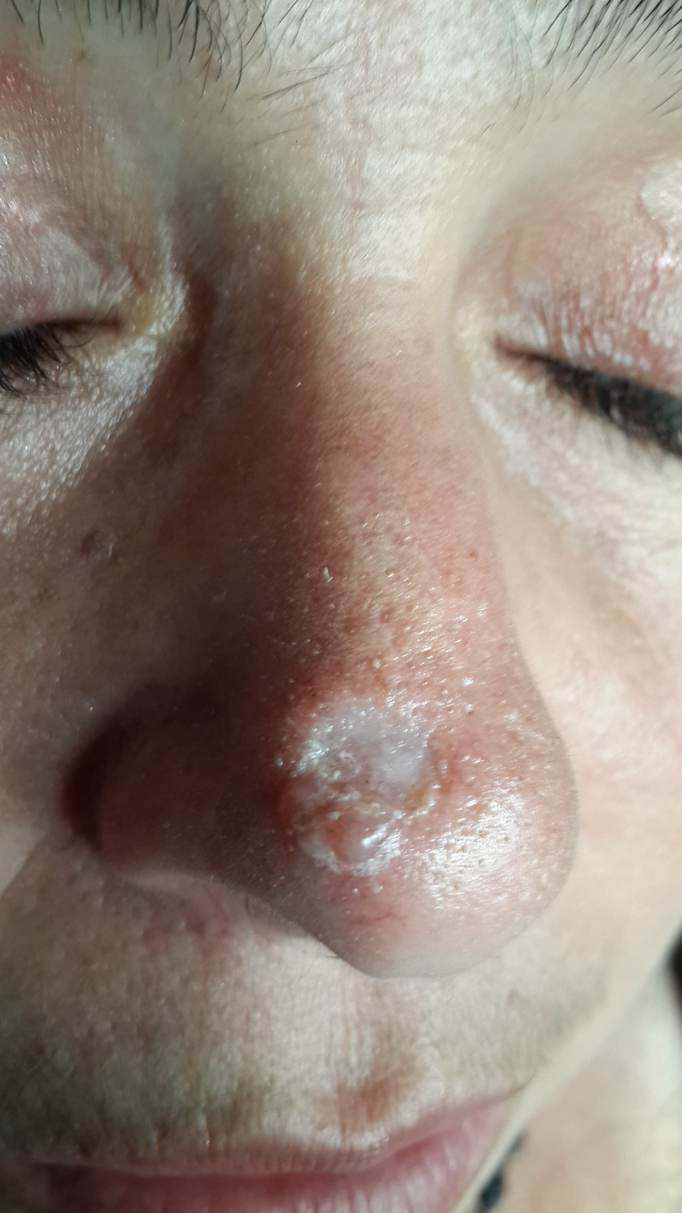 CARCINOMA BASOCELULAR DE LA NARIZ
