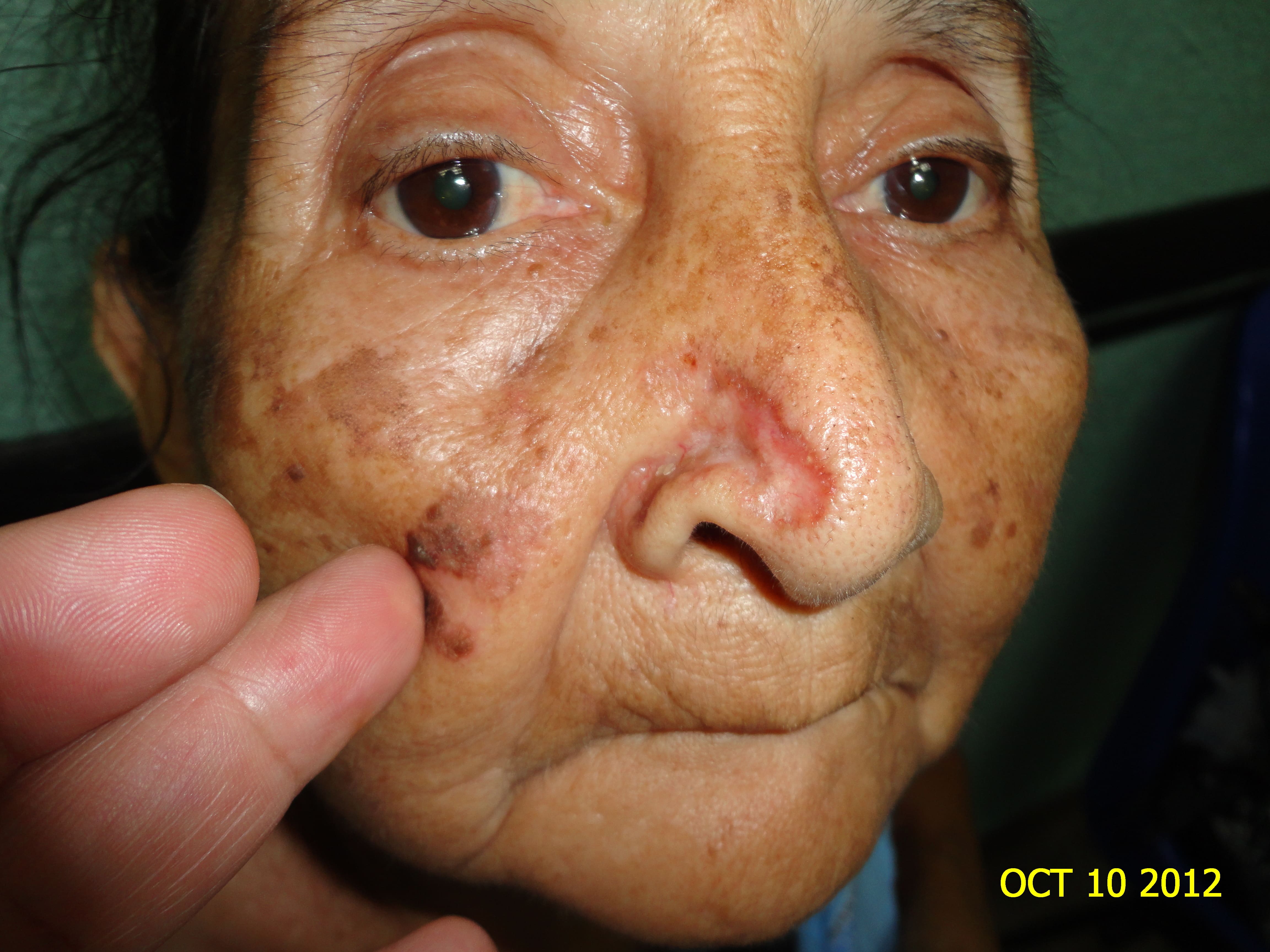 CARCINOMA BASOCELULAR DE LA NARIZ