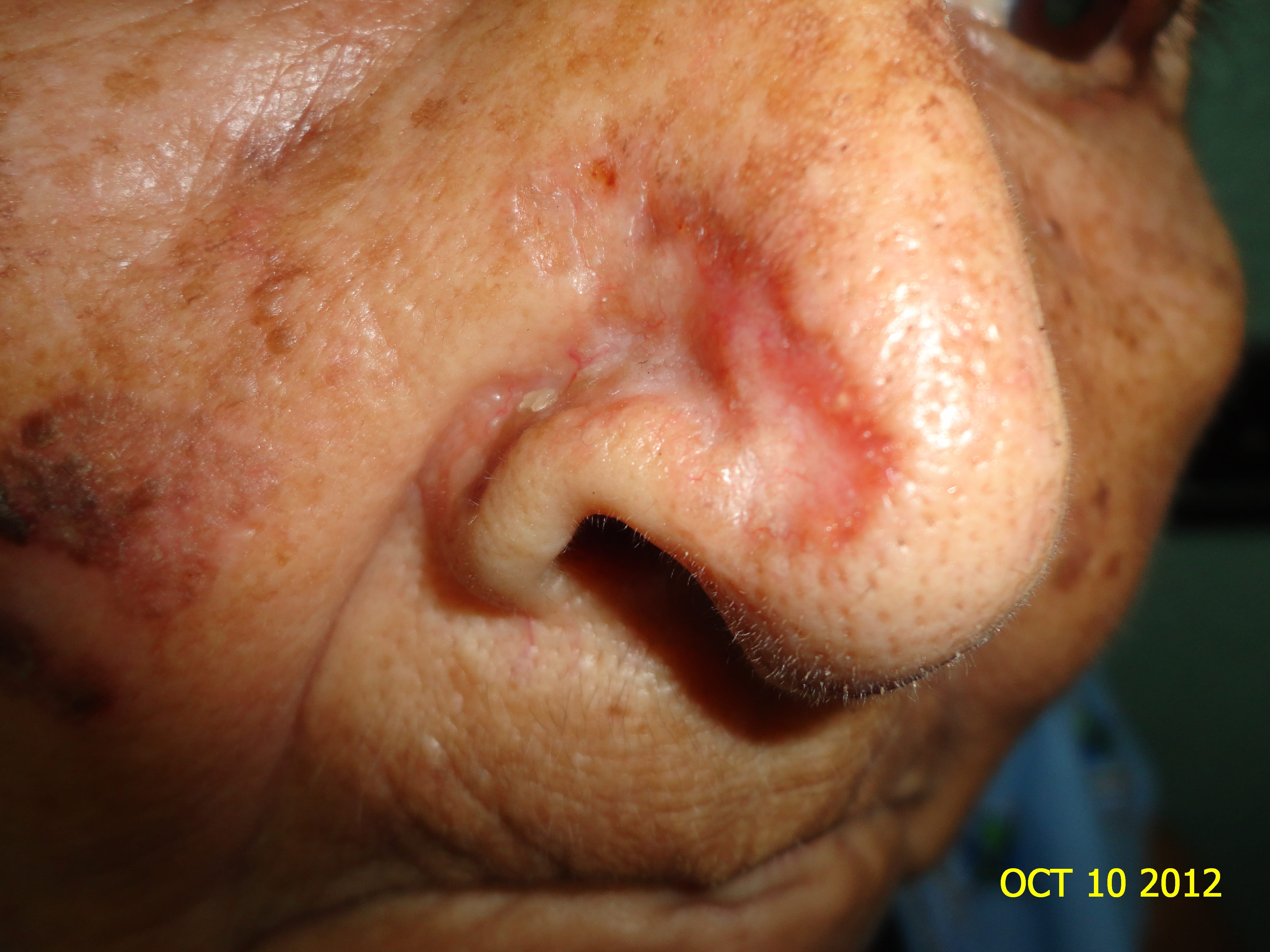 CARCINOMA BASOCELULAR DE LA NARIZ