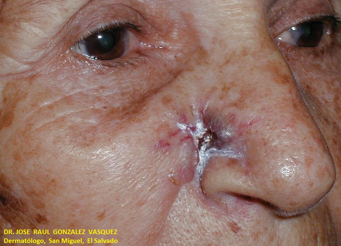 CARCINOMA BASOCELULAR DE LA NARIZ