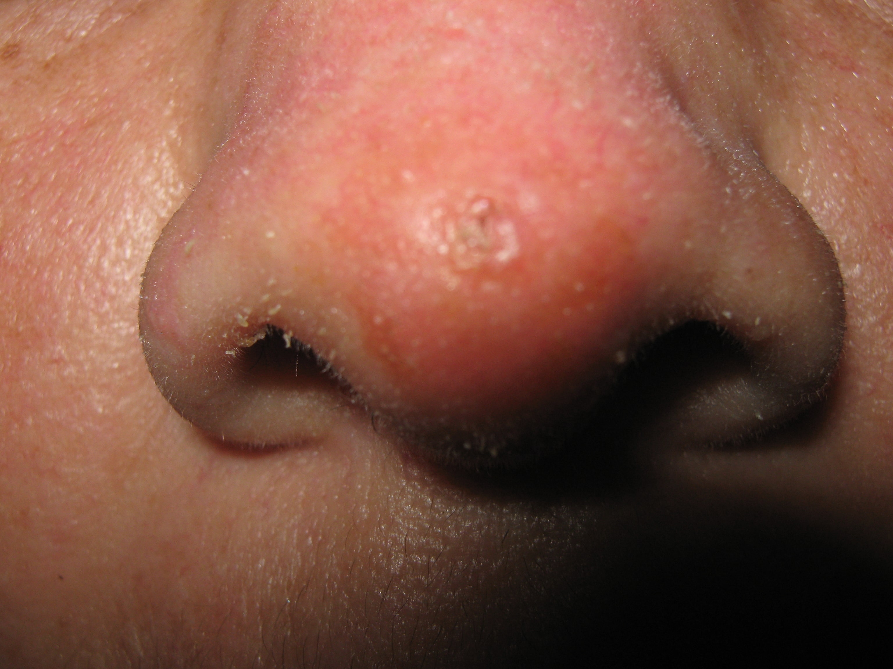CARCINOMA BASOCELULAR DE LA NARIZ