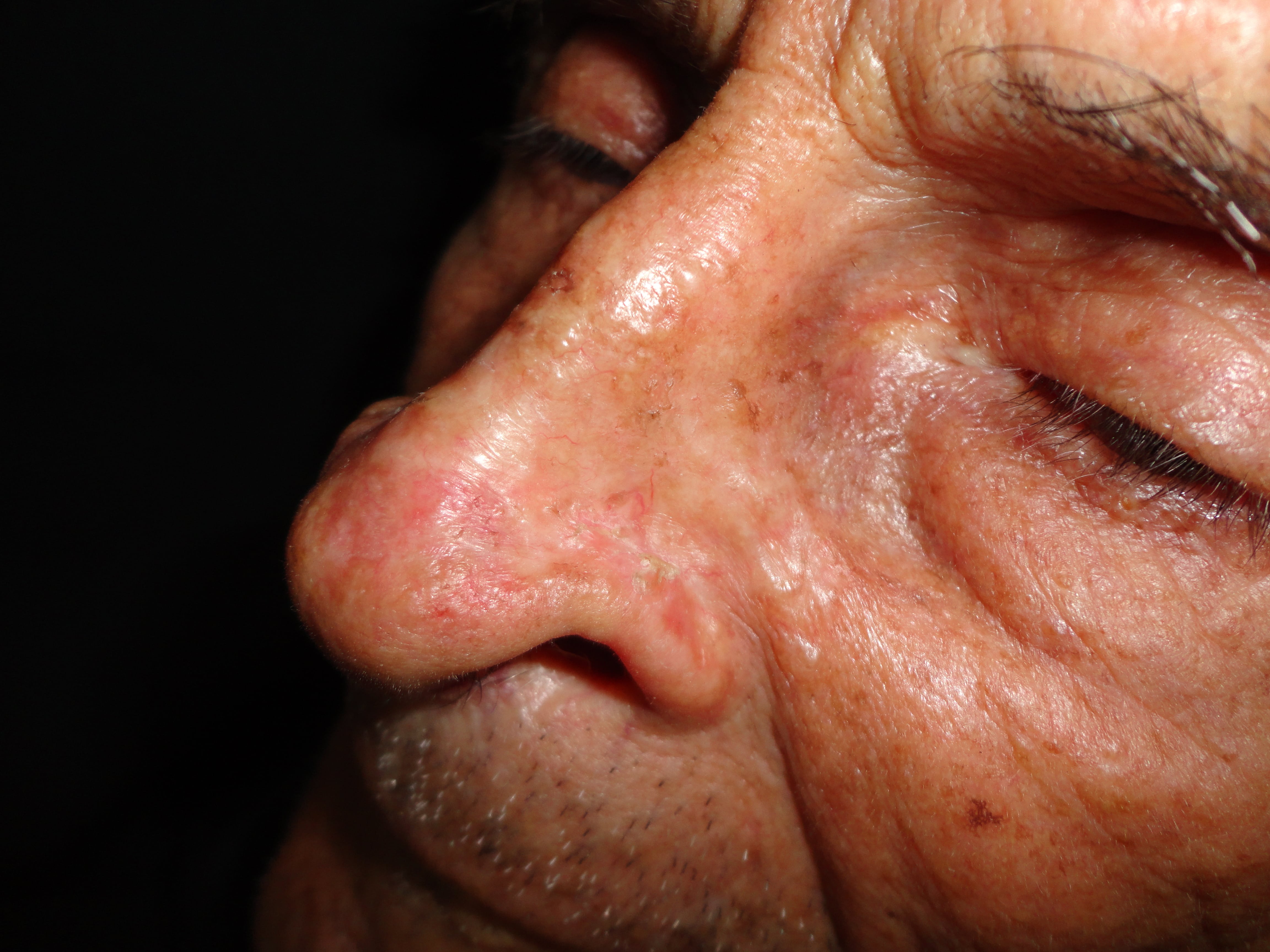 CARCINOMA BASOCELULAR DE LA NARIZ