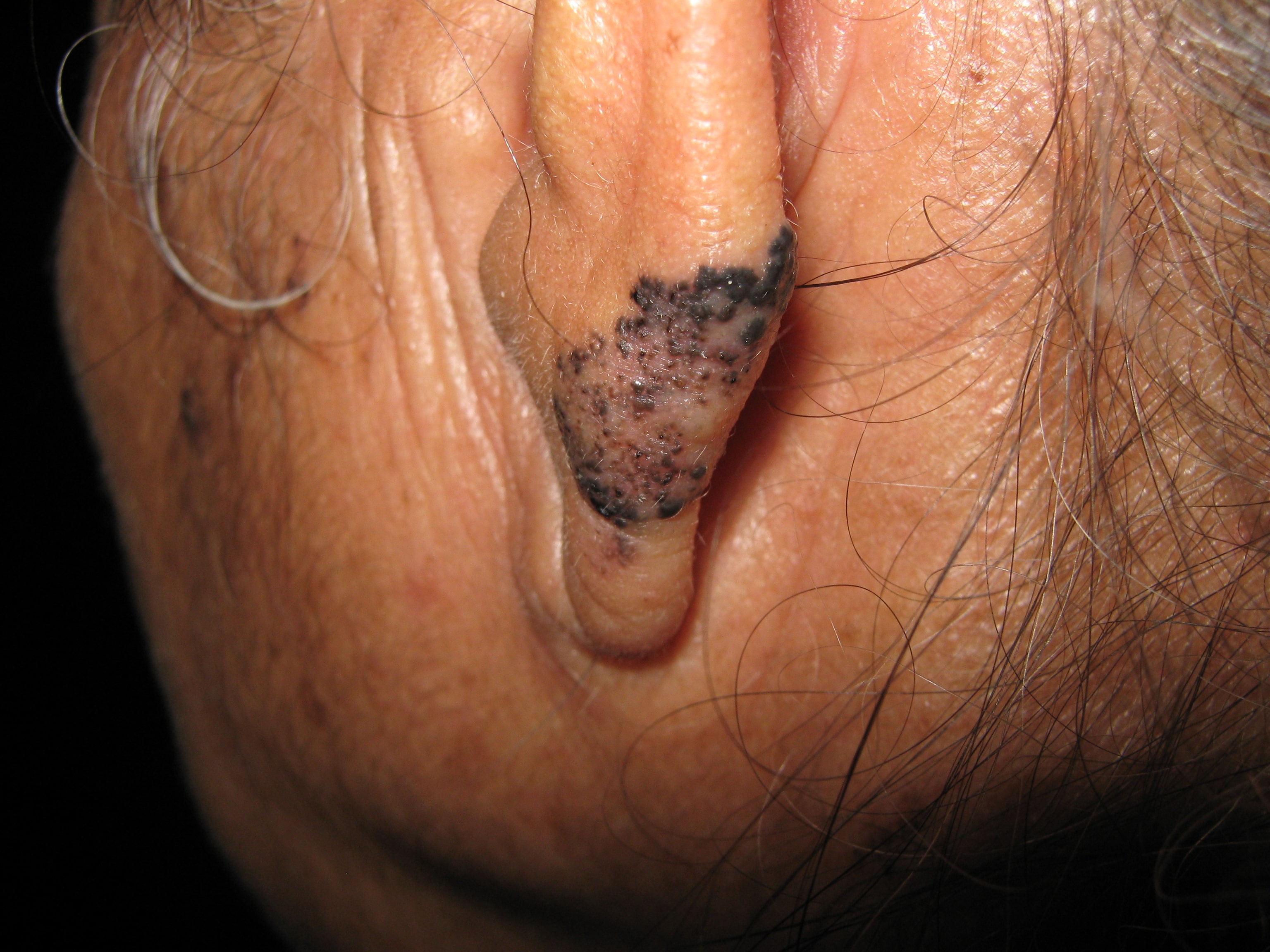 CARCINOMA BASOCELULAR DE LA OREJA