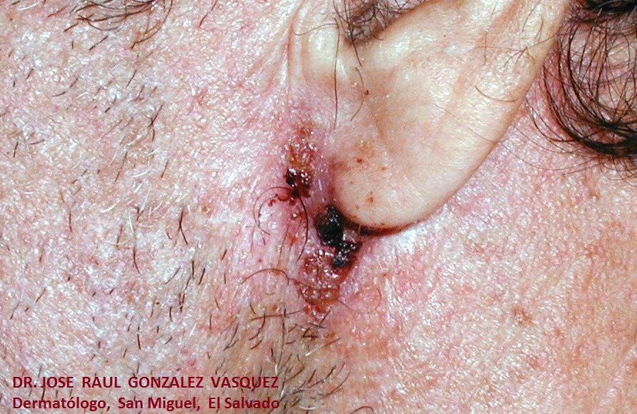 CARCINOMA BASOCELULAR ULCERADO