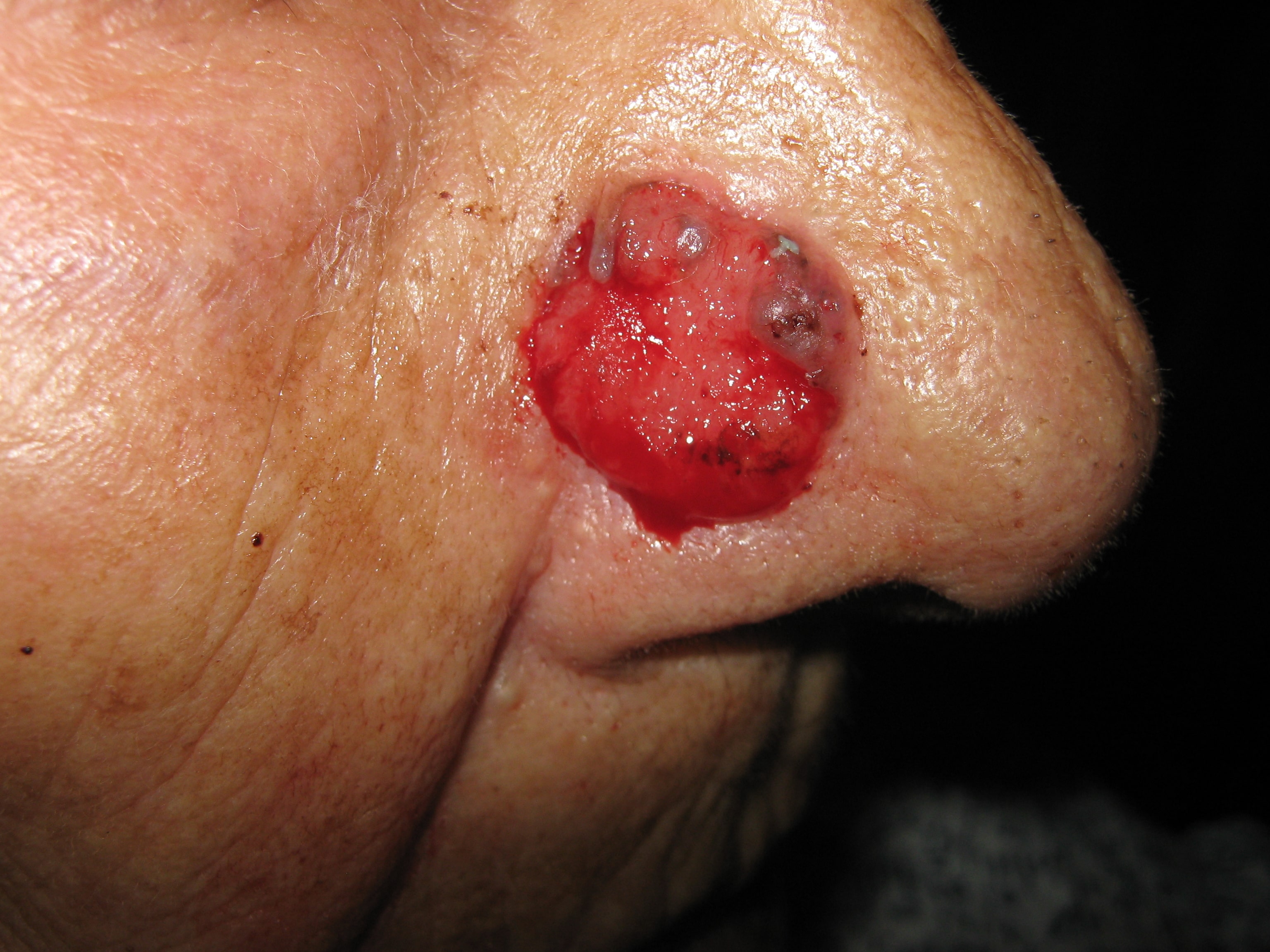 CARCINOMA BASOCELULAR ULCERADO