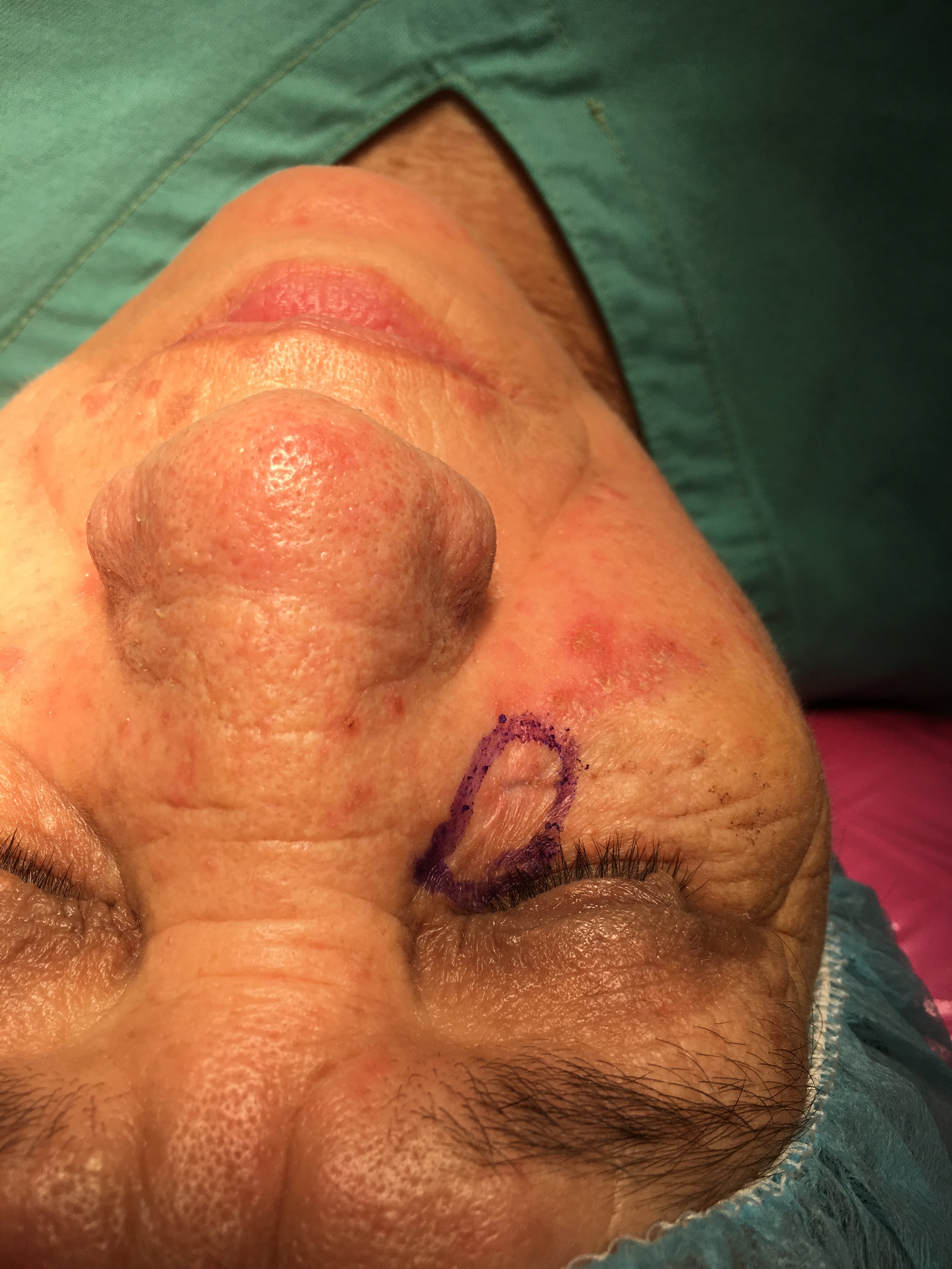 CARCINOMA BASOCELULAR y COLGAJOS
