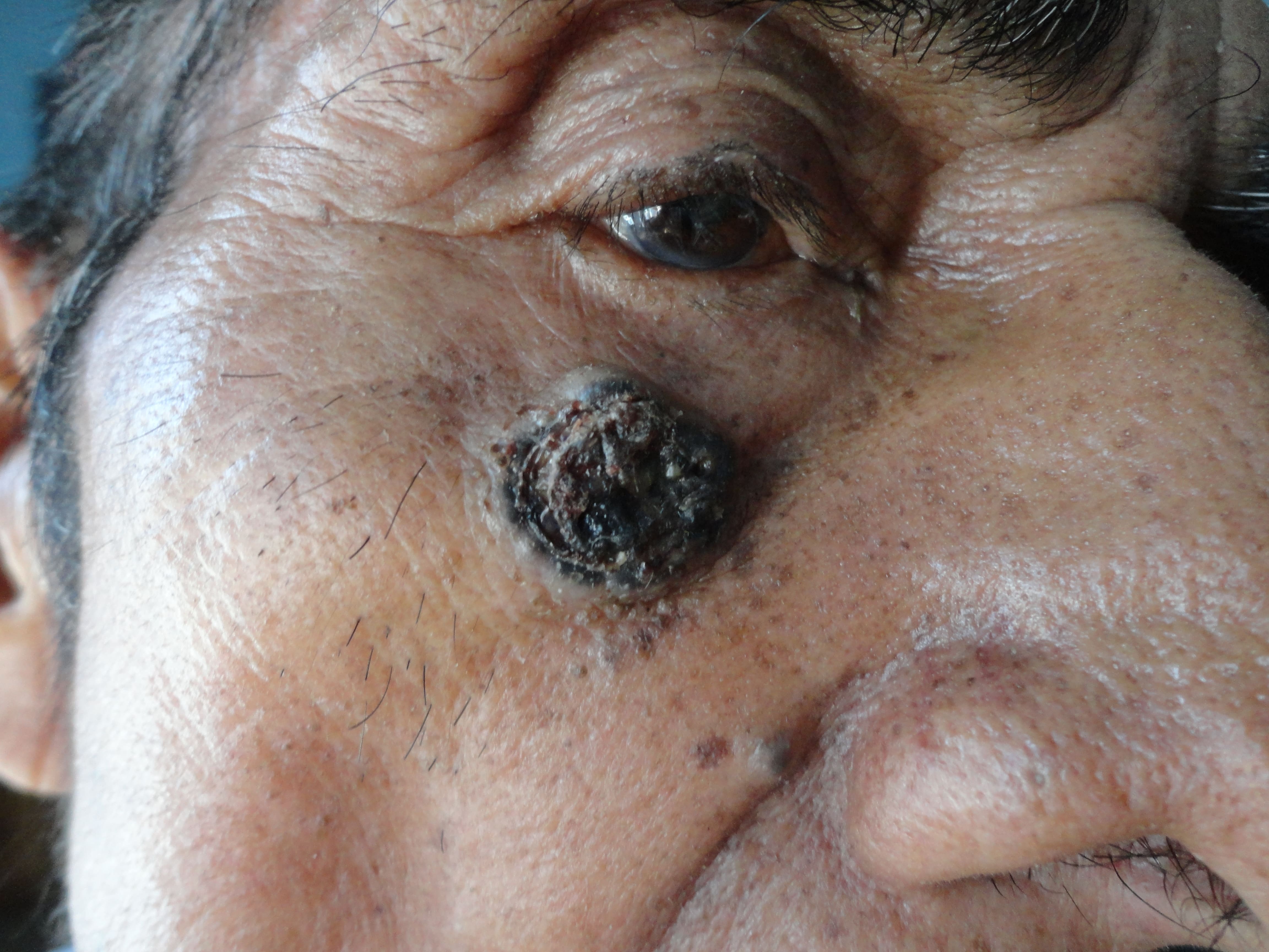 CARCINOMA BASOCELULAR DE CARA