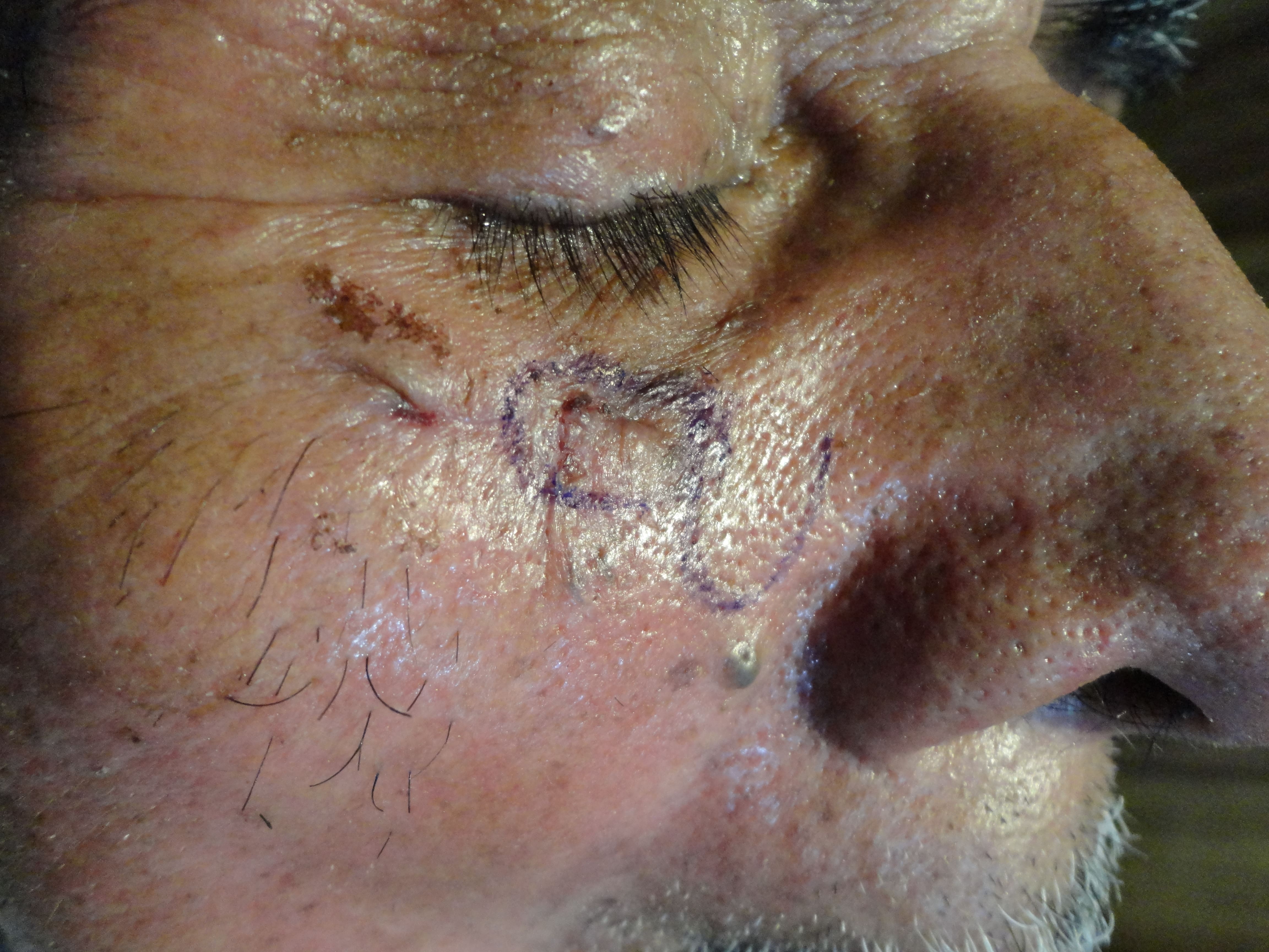 CARCINOMA BASOCELULAR DE CARA - DISEÑO COLGAJO