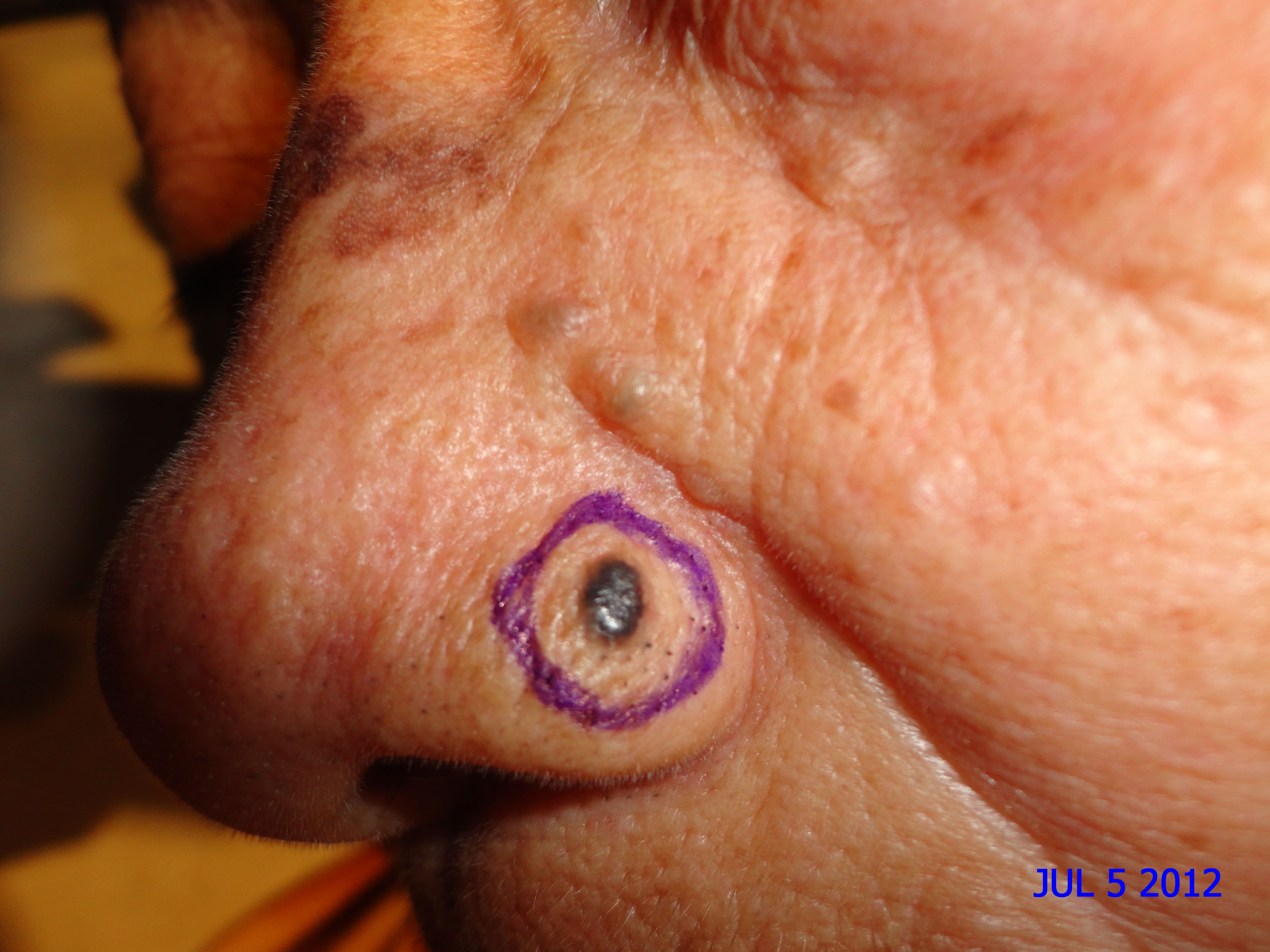 CARCINOMA BASOCELULAR DE NARIZ + CURETAJE + IMIQUIMOD