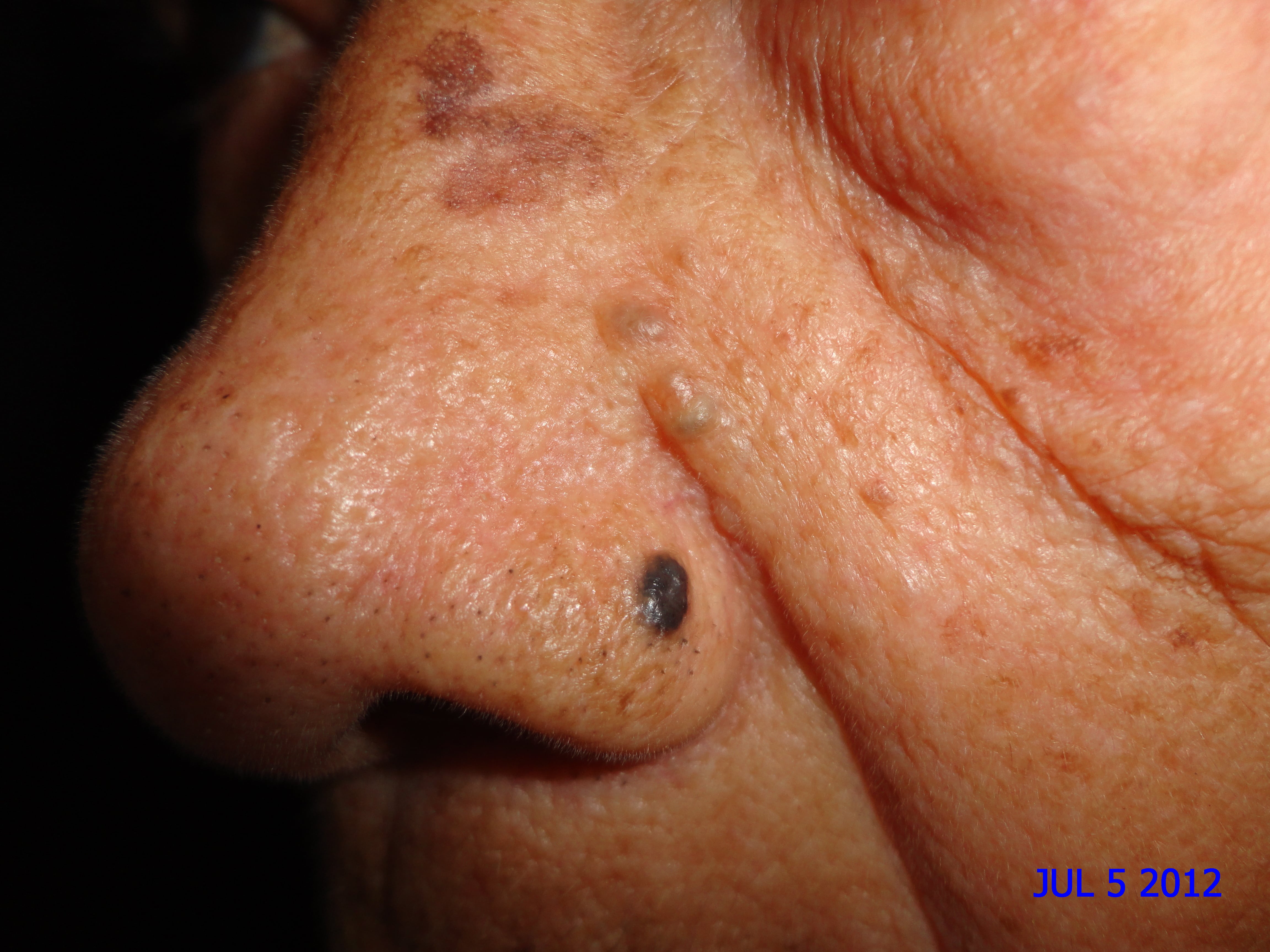 CARCINOMA BASOCELULAR DE NARIZ + CURETAJE + IMIQUIMOD